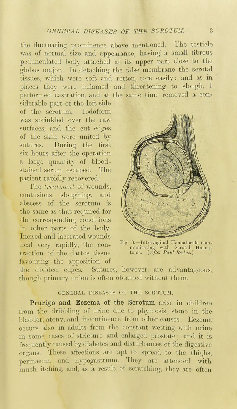 the fluctuating prominence above mentioned. The testicle was of normal size and appearance, having a small fibrous pedunculated body attached at its upper part close to the globus major. In detaching the false membrane the scrotal tissues, which were soft and rotten, tore easily; and as in places they were inflamed and threatening to slough, I performed castration, and at the same time removed a con- siderable part of the left side of the scrotum. Iodoform was sprinkled over the raw surfaces, and the cut edges of the skin Avere united by sutures. During the first six hours after the operation a large quantity of blood- stained serum escaped. The patient rapidly recovered. The treatment of wounds, contusions, sloughing, and abscess of the scrotum is the same as that required for the corresponding conditions in other parts of the body. Incised and lacerated wounds heal very rapidly, the con- traction of the dartos tissue favouring the apposition of the divided edges. Sutures, however, are advantageous, though primary union is often obtained without them. GENERAL DISEASES OF THE SCROTUM. Prurigo and Eczema of the Scrotum arise in children from the dribbling of urine due to phymosis, stone in the bladder, atony, and incontinence from other causes. Eczema occurs also in adults from the constant wetting with urine in some cases of stricture and enlarged prostate ; and it is frequently caused by diabetes and disturbances of the digestive organs. These affections are apt to spread to the thighs, perinseum, and hypogastrium. They are attended with much itching, and, as a, result of scratching, they are often Fig. 3.—Intra vaginal Hematocele com- municating with Scrotal Hsema- toma. (After Paul. Reclus.)