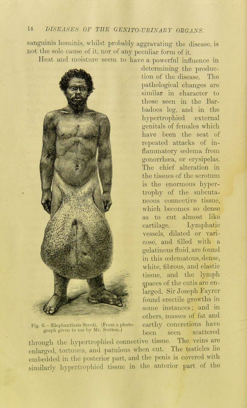 sanguinis hominis, whilst probably aggravating the disease, is not the sole cause of it, nor of any peculiar form of it. Heat and moisture seem to have a powerful influence in determining the produc- tion of the disease. The pathological changes are similar in character to those seen in the Bar- badoes leg, and in the hypertrophied external genitals of females which have been the seat of repeated attacks of in- flammatory oedema from gonorrhoea, or erysipelas. The chief alteration in the tissues of the scrotum is the enormous hyper- trophy of the subcuta- neous connective tissue, which becomes so dense as to cut almost like cartilage. Lymphatic vessels, dilated or vari- cose, and filled with a gelatinous fluid, are found in this (Edematous, dense, white, fibrous, and elastic tissue, and the lymph spaces of the cutis are en- larged. Sir Joseph Fayrer found erectile growths in some instances; and in others, masses of fat and earthy concretions have been seen scattered through the hypertrophied connective tissue. The veins are Fig. 6.--Elephantiasis Scroti. (From ft photo- graph given to me by Mr. Sutton.; enlarged, tortuous, and patulous when cut. The testicles lie embedded in the posterior part, and the penis is covered with similarly hypertrophied tissue in the anterior part of the