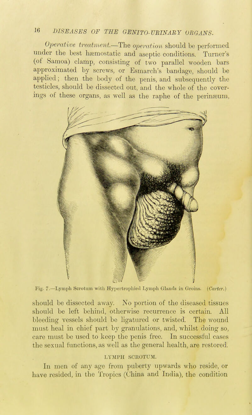 Operative treatment.—The operation should bo performed under the best haemostatic and aseptic conditions. Turner's (of Samoa) clamp, consisting of two parallel Avooden bars approximated by screws, or Esmarch's bandage, should be applied; then the body of the penis, and subsequently the testicles, should be dissected out, and the whole of the cover- ings of these organs, as well as the raphe of the perinseum, Fig. 7.—Lymph Scrotum with Hypertronhieil Lymph Glands in Groins. (Carter.) should be dissected away. No portion of the diseased tissues should be left behind, otherwise recurrence is certain. All bleeding vessels should be ligatured or twisted. The wound must heal in chief part by granulations, and, whilst doing so, care must be used to keep the penis free. In successful cases the sexual functions, as well as the general health, are restored. LYMPH SCROTUM. In men of any age from puberty upwards Avho reside, or have resided, in the Tropics (China and India), the condition