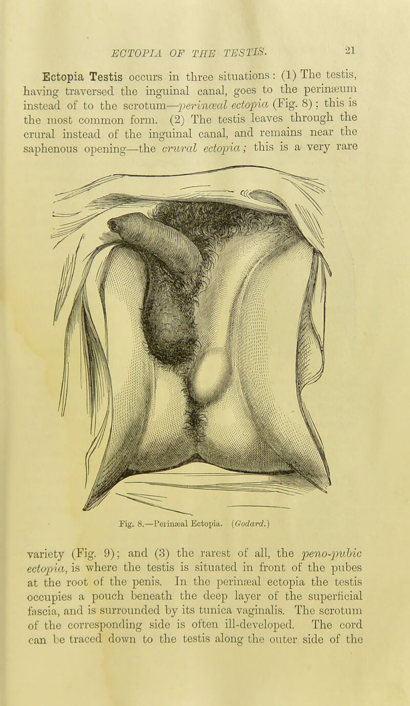 ECTOPIA OF THE TESTIS. Ectopia Testis occurs in three situations: (1) The testis, having traversed the inguinal canal, goes to the perinseum instead of to the scrotum—perinceal ectopia (Fig. 8); this is the most common form. (2) The testis leaves through the crural instead of the inguinal canal, and remains near the saphenous opening—the crural ectopia; this is a very rare Fig. 8.—Peiinaeal Ectopia. (Godard.) variety (Fig. 9); and (3) the rarest of all, the peno-pubic ectopia, is where the testis is situated in front of the pubes at the root of the penis. In the perinatal ectopia the testis occupies a pouch beneath the deep layer of the superficial fascia, and is surrounded by its tunica vaginalis. The scrotum of the corresponding side is often ill-developed. The cord can be traced down to the testis along the outer side of the