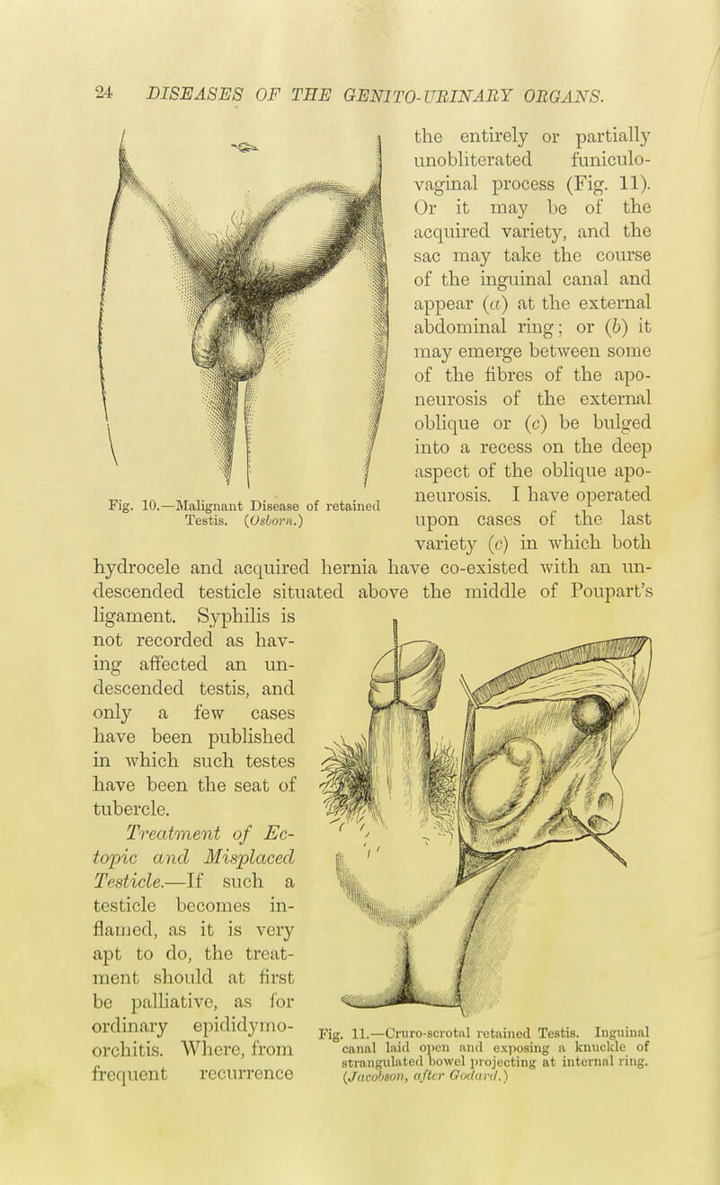 Fig. 10. -Malignant Disease of retained Testis. (Usborn.) the entirely or partially unobliteratecl funiculo- vaginal process (Fig. 11). Or it may be of the acquired variety, and the sac may take the course of the inguinal canal and appear (a) at the external abdominal ring; or (6) it may emerge between some of the fibres of the apo- neurosis of the external oblique or (c) be bulged into a recess on the deep aspect of the oblique apo- neurosis. I have operated upon cases of the last variety (c) in which both hydrocele and acquired hernia have co-existed with an un- descended testicle situated above the middle of Poupart's ligament. Syphilis is not recorded as hav- ing affected an un- descended testis, and only a few cases have been published in which such testes have been the seat of tubercle. Treatment of Ec- topic and Misplaced Testicle.—If such a testicle becomes in- flamed, as it is very apt to do, the treat- ment should at first be palliative, as for Ordinary epididymo- pig_ ui_Cruro.B01.otal retained Testis. Inguinal orchitis. Where, from canal laid open and exposing a knuckle of „ strangulated bowel projecting at internal ring. frequent recurrence (jacobson, after Godurd.)