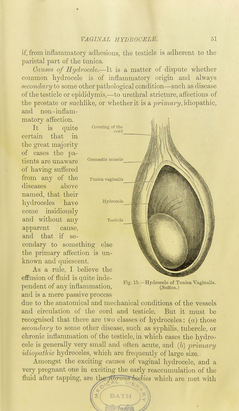 if, from inflammatory adhesions, the testicle is adherent to the parietal part of the tunica. Causes of Hydrocele.—It is a matter of dispute whether common hydrocele is of inflammatory origin and always secondary to some other pathological condition—such as disease of the testicle or epididymis,—to urethral stricture, affections of the prostate or suchlike, or Avhetherit is a primary, idiopathic, and non-inflam- matory affection. It is quite certain that in the great majority of cases the pa- tients are unaware of having suffered from any of the diseases above named, that their hydroceles have come insidiously and without any apparent cause, and that if se- condary to something else the primary affection is un- known and quiescent. As a rule, I believe the effusion of fluid is quite inde- pendent of any inflammation, and is a mere passive process due to the anatomical and mechanical conditions of the vessels and circulation of the cord and testicle. But it must be recognised that there are two classes of hydroceles: (a) those secondary to some other disease, such as syphilis, tubercle, or chronic inflammation of the testicle, in which cases the hydro- cele is generally very small and often acute, and (b) primary idiopathic hydroceles, which are frequently of large size. Amongst the exciting causes of vaginal hydrocele, and a very pregnant one in exciting the early reaccumulation of the fluid after tapping, are thg^ffioWTbodies which are met with Covering of the cord Cremastic muscle Tunica vaginalis Hydrocele Testicle Fig. 15.—Hydrocele of Tunica Vaginalis. (Sutton.)