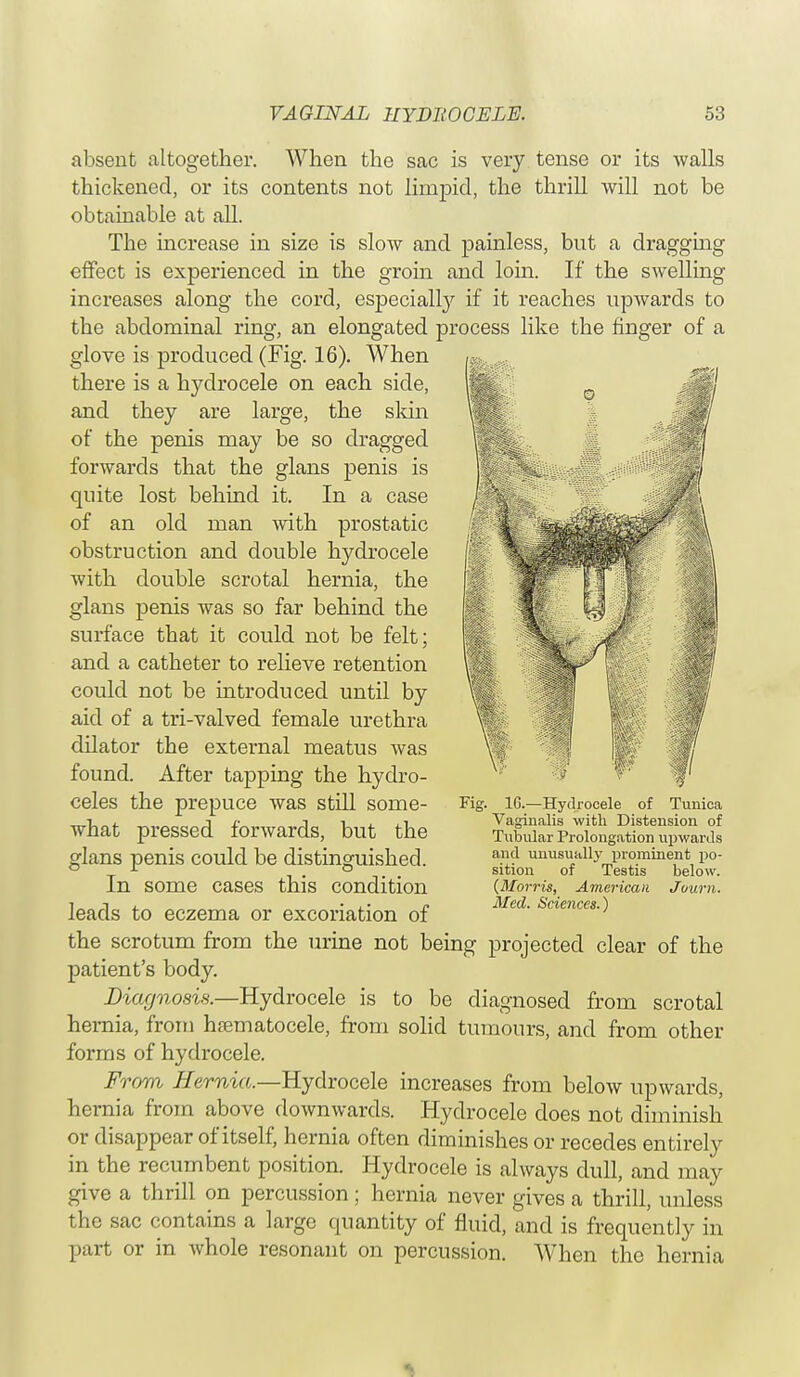 absent altogether. When the sac is very tense or its walls thickened, or its contents not limpid, the thrill will not be obtainable at all. The increase in size is slow and painless, but a dragging effect is experienced in the groin and loin. If the swelling increases along the cord, especially if it reaches upwards to the abdominal ring, an elongated process like the finger of a glove is produced (Fig. 16). When there is a hydrocele on each side, and they are large, the skin of the penis may be so dragged forwards that the glans penis is quite lost behind it. In a case of an old man with prostatic obstruction and double hydrocele with double scrotal hernia, the glans penis was so far behind the surface that it could not be felt; and a catheter to relieve retention could not be introduced until by aid of a tri-valved female urethra dilator the external meatus was found. After tapping the hydro- celes the prepuce was still some- what pressed forwards, but the glans penis could be distinguished. In some cases this condition leads to eczema or excoriation of the scrotum from the urine not being projected clear of the patient's body. Diagnosis.—Hydrocele is to be diagnosed from scrotal hernia, from hematocele, from solid tumours, and from other forms of hydrocele. Fo 'otti Hernia.—Hydrocele increases from below upwards, hernia from above downwards. Hydrocele does not diminish or disappear of itself, hernia often diminishes or recedes entirely in the recumbent position. Hydrocele is always dull, and may give a thrill on percussion ; hernia never gives a thrill, unless the sac contains a large quantity of fluid, and is frequently in part or in whole resonant on percussion. When the hernia Fig. 1G.—Hydrocele of Tunica Vaginalis with Distension of Tubular Prolongation upwards and unusually prominent po- sition of Testis below. (Morris, American Journ. Med. Sciences.)