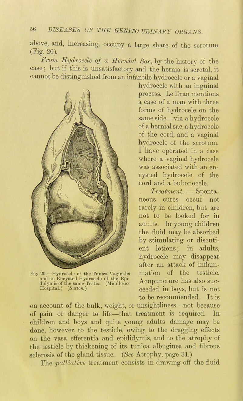 above, and, increasing, occupy a large share of the scrotum (Fig. 20). From Hydrocele of a Hernial Sac, by the history of the case; but if this is unsatisfactory and the hernia is scrotal, it cannot be distinguished from an infantile hydrocele or a vaginal hydrocele with an inguinal process. Le Dran mentions a case of a man with three forms of hydrocele on the same side—viz. a hydrocele of a hernial hydrocele of the cord, and a vaginal hydrocele of the scrotum. I have operated in a case where a vaginal hydrocele was associated with an en- cysted hydrocele of the cord and a bubonocele. Treatment. — Sponta- neous cures occur not rarely in children, but are not to be looked for in adults. In young children the fluid may be absorbed by stimulating or discuti- ent lotions; in adults, hydrocele may disappear after an attack of inflam- mation of the testicle. Acupuncture has also suc- ceeded in boys, but is not to be recommended. It is on account of the bulk, weight, or unsightliness—not because of pain or danger to life—that treatment is required. In children and boys and quite young adults damage may be done, however, to the testicle, owing to the dragging effects on the vasa efferentia and epididymis, and to the atrophy of the testicle by thickening of its tunica albuginea and fibrous sclerosis of the gland tissue. (See Atrophy, page 31.) The palliative treatment consists in drawing off the fluid Fig. 20.—Hydrocele of the Tunica Vaginalis and an Encysted Hydrocele of the Epi- didymis of the same Testis. (Middlesex Hospital.) (Sutton.)