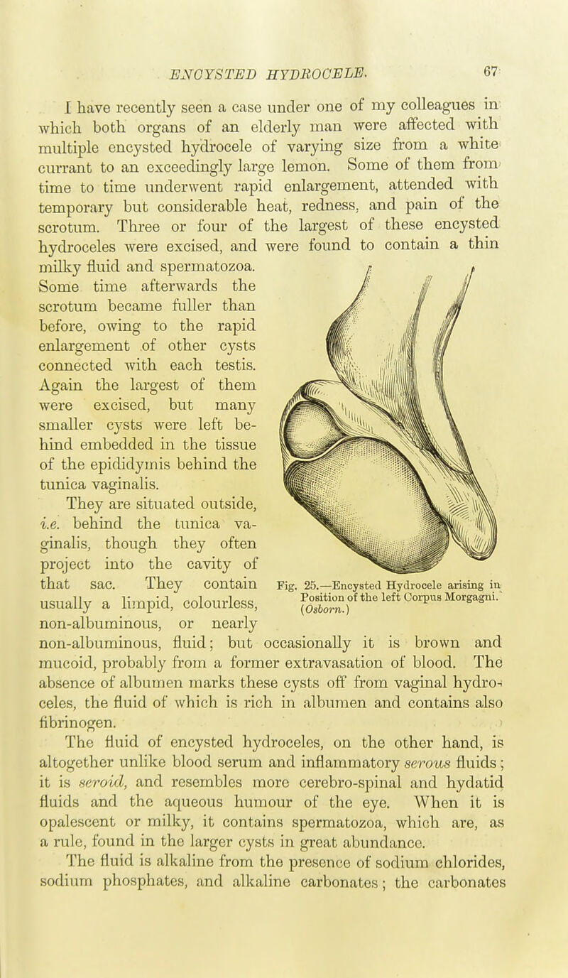 I have recently seen a case under one of my colleagues in which both organs of an elderly man were affected with multiple encysted hydrocele of varying size from a white currant to an exceedingly large lemon. Some of them from time to time underwent rapid enlargement, attended with temporary but considerable heat, redness, and pain of the scrotum. Three or four of the largest of these encysted hydroceles were excised, and were found to contain a thin milky fluid and spermatozoa. Some time afterwards the scrotum became fuller than before, owing to the rapid enlargement of other cysts connected with each testis. Again the largest of them were excised, but many smaller cysts were left be- hind embedded in the tissue of the epididymis behind the tunica vaginalis. They are situated outside, i.e. behind the tunica va- ginalis, though they often project into the cavity of that Sac. They Contain Fig. 25.—Encysted Hydrocele arising in Usually a limpid, Colourless, Position of the left Corpus Morgagni. non-albuminous, or nearly non-albuminous, fluid; but occasionally it is brown and mucoid, probably from a former extravasation of blood. The absence of albumen marks these cysts off from vaginal hydro- celes, the fluid of which is rich in albumen and contains also fibrinogen. The fluid of encysted hydroceles, on the other hand, is altogether unlike blood serum and inflammatory serous fluids; it is seroid, and resembles more cerebro-spinal and hydatid fluids and the aqueous humour of the eye. When it is opalescent or milky, it contains spermatozoa, which are, as a rule, found in the larger cysts in great abundance. The fluid is alkaline from the presence of sodium chlorides, sodium phosphates, and alkaline carbonates; the carbonates