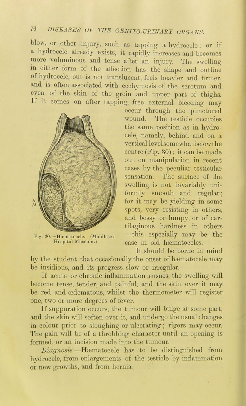 blow, or other injury, such as tapping a hydrocele; or if a hydrocele already exists, it rapidly increases and becomes more voluminous and tense after an injury. The swelling in either form of the affection has the shape and outline of hydrocele, but is not translucent, feels heavier and firmer, and is often associated with ecchymosis of the scrotum and even of the skin of the groin and upper part of thighs. If it comes on after tapping, free external bleeding may occur through the punctured wound. The testicle occupies the same position as in hydro- cele, namely, behind and on a vertical levelsomewhatbelow the centre (Fig. 30); it can be made out on manipulation in recent cases by the peculiar testicular sensation. The surface of the swelling is not invariably uni- formly smooth and regular; for it may be yielding in some spots, very resisting in others, and bossy or lumpy, or of car- tilaginous hardness in others ■—this especially may be the case in old hematoceles. It should be borne in mind by the student that occasionally the onset of haBinatocele may be insidious, and its progress slow or irregular. If acute or chronic inflammation ensues, the swelling will become tense, tender, and painful, and the skin over it may be red and oedematous, whilst the thermometer will register one, two or more degrees of fever. If suppuration occurs, the tumour will bulge at some part, and the skin will soften over it, and undergo the usual changes in colour prior to sloughing or ulcerating; rigors may occur. The pain will be of a throbbing character until an opening is formed, or an iiicision made into the tumour. Diagnosis.—Hematocele has to be distinguished from hydrocele, from enlargements of the testicle by inflammation or new growths, and from hernia. Fig. 30. — Hematocele. (Middlesex Hospital Museum.)