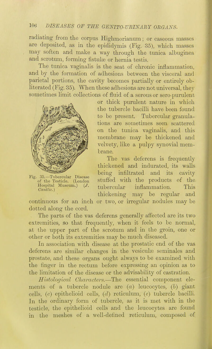 radiating froin the corpus Highmorianum; or caseous masses are deposited, as in the epididymis (Fig. 35), which masses may soften and make a way through the tunica albuginea and scrotum, forming fistulse or hernia testis. The tunica vaginalis is the seat of chronic inflammation, and by the formation of adhesions between the visceral and parietal portions, the cavity becomes partially or entirely ob- literated (Fig. 35). When these adhesions are not universal, they sometimes limit collections of fluid of a serous or sero-purulent or thick purulent nature in which the tubercle bacilli have been found to be present. Tubercular granula- tions are sometimes seen scattered on the tunica vaginalis, and this membrane may be thickened and velvety, like a pulpy synovial mem- brane. The vas deferens is frequently thickened and indurated, its walls being infiltrated and its cavity stuffed with the products of the tubercular inflammation. This thickening may be regular and continuous for an inch or two, or irregular nodules may be clotted along the cord. The parts of the vas deferens generally affected are its two extremities, so that frequently, when it feels to be normal, at the upper part of the scrotum and in the groin, one or other or both its extremities may be much diseased. In association with disease at the prostatic end of the vas deferens are similar changes in the vesiculce seminales and prostate, and these organs ought always to be examined with the finger in the rectum before expressing an opinion as to the limitation of the disease or the advisability of castration. Histological Cha/ract&rs.—The essential component ele- ments of a tubercle nodule are (a) leucocj^tes, (b) giant cells, (c) epithelioid cells, (d) reticulum, (e) tubercle bacilli. In the ordinary form of tubercle, as it is met with in the testicle, the epithelioid cells and the leucocytes are found in the meshes of a wcll-detined reticulum, composed of Fig. 35.—Tubercular Disease of the Testicle. (London Hospital Museum.) (J. Cantlic.)