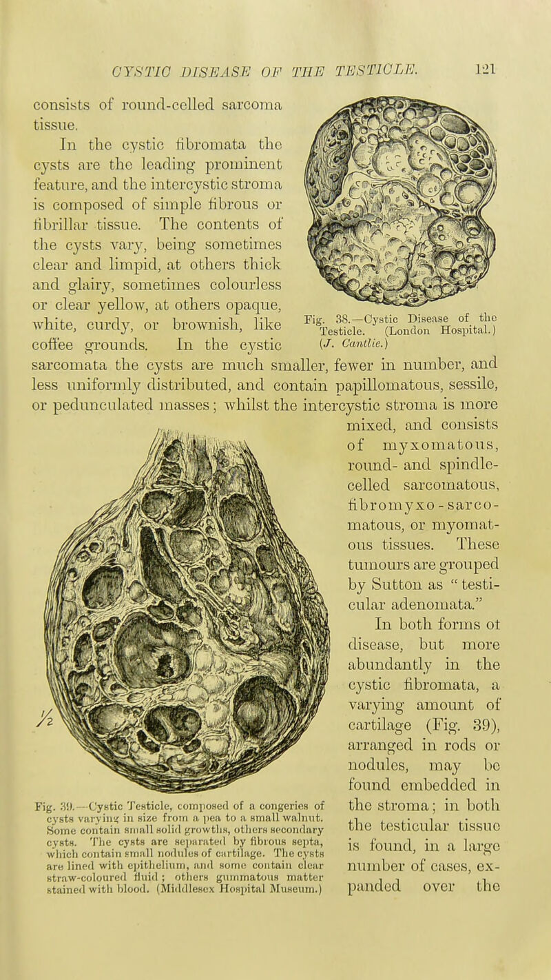 Fig. 38.—Cystic Disease of the Testicle. (London Hospital.) (J. Cantlic.) consists of round-celled sarcoma tissue. In the cystic fibromata the cysts are the leading prominent feature, and the intercystic stroma is composed of simple fibrous or fibrillar tissue. The contents of the cysts vary, being sometimes clear and limpid, at others thick and glairy, sometimes colourless or clear yellow, at others opaque, white, curdy, or brownish, like coffee grounds. In the cj^stic sarcomata the cysts are much smaller, fewer in number, and less uniformly distributed, and contain papillomatous, sessile, or pedunculated masses; whilst the intercystic stroma is more mixed, and consists of myxomatous, round- and spindle- celled sarcomatous, fibromyxo - sarco- matous, or myomat- ous tissues. These tumours are grouped by Sutton as  testi- cular adenomata. In both forms ot disease, but more abundantly in the cystic fibromata, a varying amount of cartilage (Fig. 39), arranged in rods or nodules, may be found embedded in the stroma; in both the testicular tissue is found, in a large number of cases, ex- panded over the Fig. 39. Cystic Testicle, composed of a congeries of cysts varying in size from a pea to a small walnut. Some contain small solid growths, others secondary cysts. The cysts are separated by fibrous septa, which contain small nodules of cartilage. The cysts are lined with epithelium, and some contain clear straw-coloured fluid ; others gummatous matter stained with blood. (Middlesex Hospital Museum.)