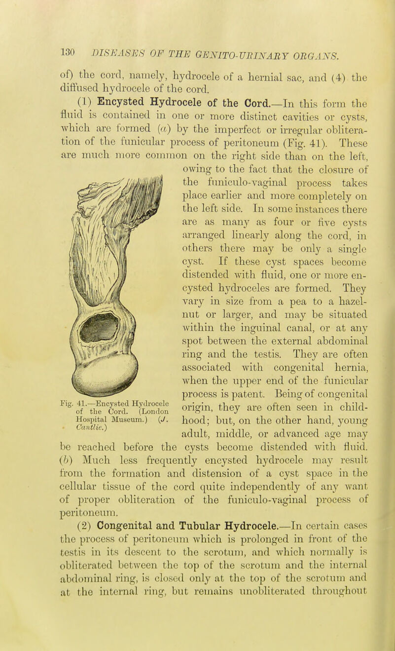 of) the cord, namely, hydrocele of a hernial sac, and (4) the diffused hydrocele of the cord. (1) Encysted Hydrocele of the Cord.—In this form the fluid is contained in one or more distinct cavities or cysts, which arc formed (a) by the imperfect or irregular oblitera- tion of the funicular process of peritoneum (Fig. 41). These are much more common on the right side than on the left, owing to the fact that the closure of the funiculo-vaginal process takes place earlier and more completely on the left side. In some instances there are as many as four or five cysts arranged linearly along the cord, in others there may be only a single cyst. If these cyst spaces become distended with fluid, one or more en- cysted hydroceles are formed. They vary in size from a pea to a hazel- nut or larger, and may be situated within the inguinal canal, or at any spot between the external abdominal ring and the testis. They are often associated with congenital hernia, when the upper end of the funicular process is patent. Being of congenital origin, they are often seen in child- hood; but, on the other hand, young adult, middle, or advanced age may be reached before the cysts become distended with fluid. (I>) Much less frequently encysted hydrocele may result from the formation and distension of a cyst space in the cellular tissue of the cord quite independently of any want of proper obliteration of the funiculo-vaginal process of peritoneum. (2) Congenital and Tubular Hydrocele.—In certain cases the process of peritoneum which is prolonged in front of the testis in its descent to the scrotum, and which normally is obliterated between the top of the scrotum and the internal abdominal ring, is closed only at the top of the scrotum and at the internal ring, but remains unobliterated throughout Fig. 41.—Encysted Hydrocele of the Cord. (London Hospital Museum.) (J. Cantlic.)