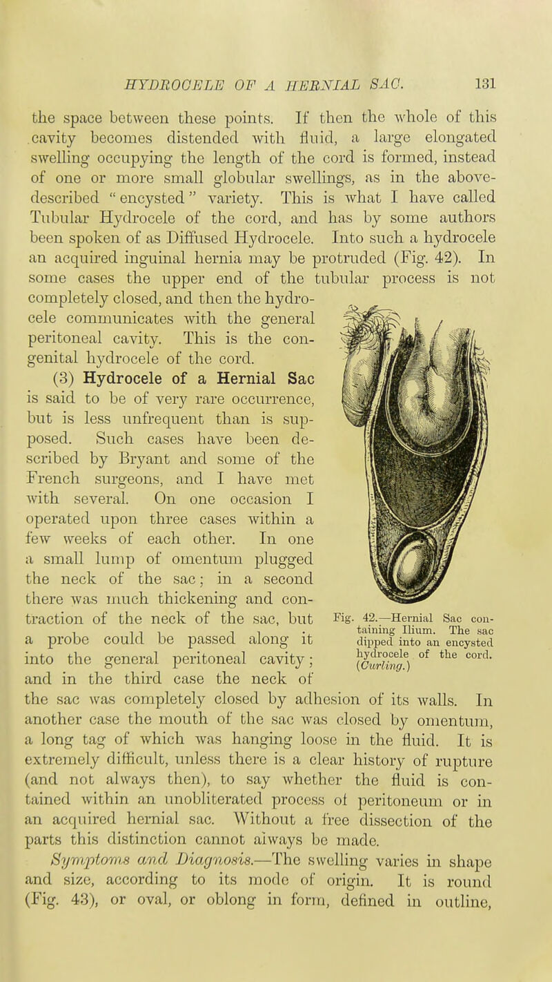 the space between these points. If* then the -whole of this cavity becomes distended with fluid, a large elongated swelling occupying the length of* the cord is formed, instead of one or more small globular swellings, as in the above- described  encysted variety. This is what I have called Tubular Hydrocele of the cord, and has by some authors been spoken of as Diffused Hydrocele. Into such a hydrocele an acquired inguinal hernia may be protruded (Fig. 42). In some cases the upper end of the tubular process is not completely closed, and then the hydro- cele communicates with the general peritoneal cavity. This is the con- genital hydrocele of the cord. (3) Hydrocele of a Hernial Sac is said to be of veiy rare occurrence, but is less unfrequent than is sup- posed. Such cases have been de- scribed by Bryant and some of the French surgeons, and I have met with several. On one occasion I operated upon three cases within a few weeks of each other. In one a small lump of omentum plugged the neck of the sac; in a second there was much thickening and con- traction of the neck of the sac, but a probe could be passed along it into the general peritoneal cavity; and in the third case the neck of the sac was completely closed by adhesion of its walls. In another case the mouth of the sac was closed by omentum, a long tag of which was hanging loose in the fluid. It is extremely difficult, unless there is a clear history of rupture (and not always then), to say whether the fluid is con- tained within an unobliterated process of peritoneum or in an acquired hernial sac. Without a free dissection of the parts this distinction cannot always be made. Symptoms and Diagnosis.—The swelling varies in shape and size, according to its mode of origin. It is round (Fig. 43), or oval, or oblong in form, defined in outline, Fig. 42.—Hernial Sac con- taining Ilium. The sac dipped into an encysted hydrocele of the cord. (Curling.)