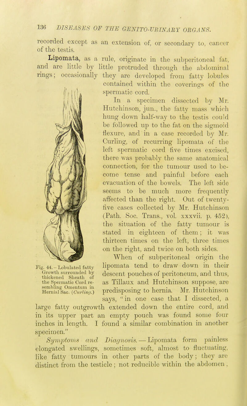 recorded except as an extension of, or secondary to, cancer of the testis. Lipomata, as a rule, originate in the subperitoneal fat, and are little by little protruded through the abdominal rings; occasionally they are developed from fatty lobules contained within the coverings of the spermatic cord. In a specimen dissected by Mr. Hutchinson, jun., the fatty mass which hung down half-way to the testis could be followed up to the fat on the sigmoid flexure, and in a case recorded by Mr. Curling, of recurring lipomata of the left spermatic cord five times excised, there was probabfy the same anatomical connection, for the tumour used to be- come tense and painful before each evacuation of the bowels. The left side seems to be much more frequently affected than the right. Out of twenty- five cases collected by Mr. Hutchinson (Path. Soc. Trans., vol. xxxvii. p. 452), the situation of the fatty tumour is stated in eighteen of them: it was thirteen times on the left, three times on the right, and twice on both sides. When of subperitoneal origin the Pig. 44. - Lobuiated fatty lipomata tend to draw down in their SckSed^Sb^tl? of d*38061^ pouches of peritoneum, and thus, the Spermatic Cord re- as Tillaux and Hutchinson suppose, are sembling Omentum in <■• . i • at tt ^ 1 • Hemiaisac. [Curling.) predisposing to hernia. Mr. Hutchmson says,  in one case that I dissected, a large fatty outgrowth extended down the entire cord, and in its upper part an empty pouch was found some four inches in length. I found a similar combination in another specimen. Synyotoms and Dicujnosis. — Lipomata form painless elongated swellings, sometimes soft, almost to fluctuating, like fatty tumours in other parts of the body; they are distinct from the testicle; not reducible within the abdomen .