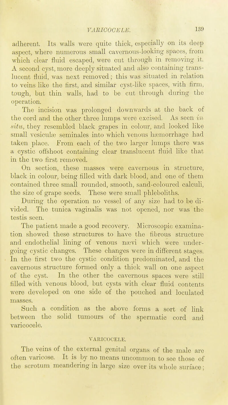 adherent. Its walls were quite thick, especially on its deep aspect, where numerous small cavernous-looking spaces, from which clear fluid escaped, were cut through in removing it. A second cyst, more deeply situated and also containing trans- lucent fluid, was next removed; this was situated in relation to veins like the first, and similar cyst-like spaces, with firm, tough, but thin walls, had to be cut through during the operation. The incision was prolonged downwards at the back of the cord and the other three lumps were excised. As seen in situ, they resembled black grapes in colour, and looked like small vesicuke seminales into which venous haemorrhage had taken place. From each of the two larger lumps there was a cystic offshoot containing clear translucent fluid like that in the two first removed. On section, these masses were cavernous in structure, black in colour, being filled with dark blood, and one of them contained three small rounded, smooth, sand-coloured calculi, the size of grape seeds. These were small phleboliths. During the operation no vessel of any size had to be di- vided. The tunica vaginalis was not opened, nor was the testis seen. The patient made a good recovery. Microscopic examina- tion showed these structures to have the fibrous structure and endothelial lining of venous nam which were under- going cystic changes. These changes were in different stages. In the first two the cystic condition predominated, and the cavernous structure formed only a thick wall on one aspect of the cyst. In the other the cavernous spaces were still filled with venous blood, but cysts with clear fluid contents were developed on one side of the pouched and loculated masses. Such a condition as the above forms a sort of link between the solid tumours of the spermatic cord and varicocele. VARICOCELE The veins of the external genital organs of the male arc often varicose. It is by no means uncommon to see those of the scrotum meandering in large size over its whole surface;
