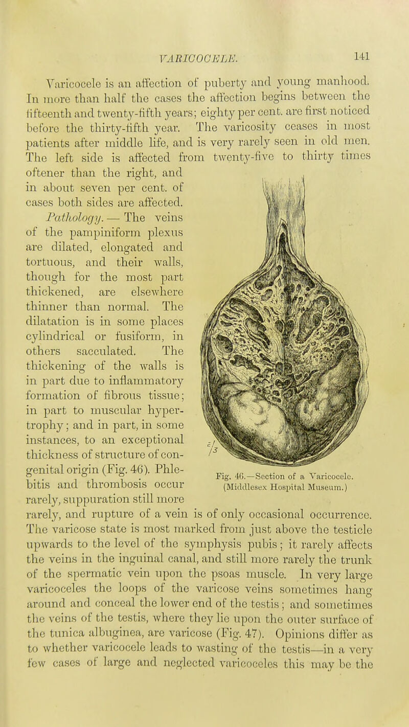 Varicocele is an affection of puberty and young manhood. Tn more than half the cases the affection begins between the fifteenth and twenty-fifth years; eighty per cent, are first noticed before the thirty-fifth year. The varicosity ceases in most patients after middle life, and is very rarely seen in old men. The left side is affected from twenty-five to thirty times oftener than the right, and in about seven per cent, of cases both sides are affected. Pathology.— The veins of the pampiniform plexus are dilated, elongated and tortuous, and their walls, though for the most part thickened, are elsewhere thinner than normal. The dilatation is in some places cylindrical or fusiform, in others sacculated. The thickening of the walls is in part due to inflammatory formation of fibrous tissue; in part to muscular hyper- trophy ; and in part, in some instances, to an exceptional thickness of structure of con- genital origin (Fig. 46). Phle- bitis and thrombosis occur rarely, suppuration still more rarely, and rupture of a vein is of only occasional occurrence. The varicose state is most marked from just above the testicle upwards to the level of the symphysis pubis; it rarely affects the veins in the inguinal canal, and still more rarely the trunk of the spermatic vein upon the psoas muscle. In very large varicoceles the loops of the varicose veins sometimes hang around and conceal the lower end of the testis; and sometimes the veins of the testis, where they lie upon the outer surface of the tunica albuginea, are varicose (Fig. 47). Opinions differ as to whether varicocele leads to wasting of the testis—in a very few cases of large and neglected varicoceles this may be the Fig. 40.—Section of a Varicocele. (Middlesex Hospital Museum.)