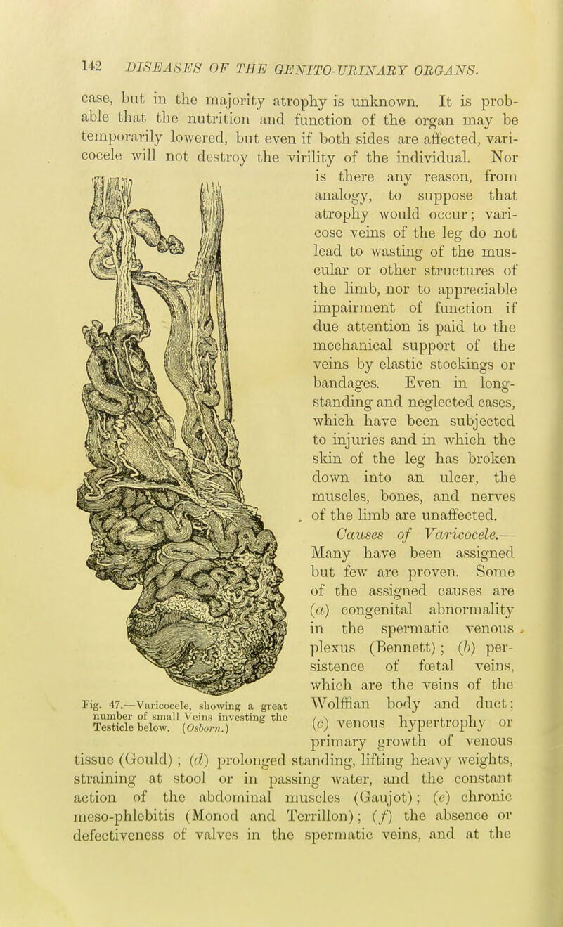 case, but in the majority atrophy is unknown. It is prob- able that the nutrition and function of the organ may be temporarily lowered, but even if both sides arc affected, vari- cocele will not destroy the virility of the individual. Nor is there any reason, from analogy, to suppose that atrophy would occur; vari- cose veins of the leg do not lead to wasting of the mus- cular or other structures of the limb, nor to appreciable impairment of function if due attention is paid to the mechanical support of the veins by elastic stockings or bandages. Even in long- standing and neglected cases, which have been subjected to injuries and in which the skin of the leg has broken down into an ulcer, the muscles, bones, and nerves of the limb are unaffected. Causes of Varicocele.— Many have been assigned but few are proven. Some of the assigned causes are (a) congenital abnormalit}^ in the spermatic venous , plexus (Bennett) ; (b) per- sistence of foetal veins, which are the veins of the Fig. 47.—Varicocele, showing a great Wolffian body and duct: number of small Veins investing the /.\ ,rflTln... K-imorfrn-nhv nr Testicle below. (Osbovn.) ic) VeilOUS UvpeitlOpliy 01 primary growth of venous tissue (Gould) ; (d) prolonged standing, lifting heavy weights, straining at stool or in passing water, and the constant action of the abdominal muscles (Gaujot); (e) chronic mcso-phlcbitis (Monod and Tcrrillon); (/) the absence or defectiveness of valves in the spermatic veins, and at the