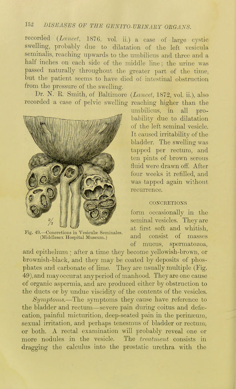 recorded (Lomeet, 1876, vol. ii.) a case of large cystic swelling, probably due to dilatation of the left vesicula seminalis, reaching upwards to the umbilicus and three and a half inches on each side of the middle line; the urine was passed naturally throughout the greater part of the time, but the patient seems to have died of intestinal obstruction from the pressure of the swelling. Dr. N. R Smith, of Baltimore (Lancet, 1872, vol. ii.), also recorded a case of pelvic swelling reaching higher than the umbilicus, in all }:>ro- bability due to dilatation of the left seminal vesicle. It caused irritability of the bladder. The swelling was tapped per rectum, and ten pints of brown serous fluid were drawn off. After four weeks it refilled, and was tapped again without recurrence. CONCRETIONS form occasionally in the seminal vesicles. They are at first soft and whitish, Fig. 49.—Concretions in Vesicula? Seminales. , . (Middlesex Hospital Museum.) and consist oi masses of mucus, spermatozoa, and epithelium • after a time they become yellowish-brown, or brownish-black, and they may be coated by deposits of phos- phates and carbonate of lime. They are usually multiple (Fig. 49),and may occurat any period of manhood. They are one cause of organic asperinia, and are produced either by obstruction to the ducts or by undue viscidity of the contents of the vesicles. Symptoms.—The symptoms they cause have reference to the bladder and rectum—severe pain during coitus and defal- cation, painful micturition, deep-seated pain in the perinaeum, sexual irritation, and perhaps tenesmus of bladder or rectum, or both. A rectal examination will probably reveal one or more nodules in the vesicle. The treatment consists in dragging the calculus into the prostatic urethra with the