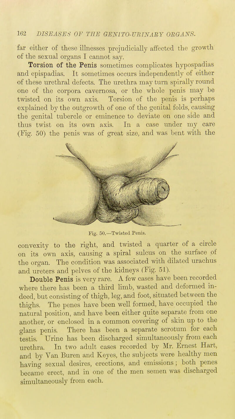 far either of these illnesses prejudicially affected the growth of the sexual organs I cannot say. Torsion of the Penis sometimes complicates hypospadias and epispadias. It sometimes occurs independently of either of these urethral defects. The urethra may turn spirally round one of the corpora cavernosa, or the whole penis may be twisted on its own axis. Torsion of the penis is perhaps explained by the outgrowth of one of the genital folds, causing the genital tubercle or eminence to deviate on one side and thus twist on its own axis. In a case under my care (Fig. 50) the penis was of great size, and was bent with the Fig. 50.—Twisted Penis. convexity to the right, and twisted a quarter of a circle on its own axis, causing a spiral sulcus on the surface of the organ. The condition was associated with dilated urachus and ureters and pelves of the kidneys (Fig. 51). Double Penis is very rare. A few cases have been recorded where there has been a third limb, wasted and deformed in- deed, but consisting of thigh, leg, and foot, situated between the thighs. The penes have been well formed, have occupied the natural position, and have been either quite separate from one another, or enclosed in a common covering of skin up to the glans penis. There has been a separate scrotum for each testis. Urine has been discharged simultaneously from each urethra. In two adult cases recorded by Mr. Ernest Hart, and by Van Buren and Keyes, the subjects wore healthy men having sexual desires, erections, and emissions; both penes became erect, and in one of the men semen was discharged simultaneously from each.