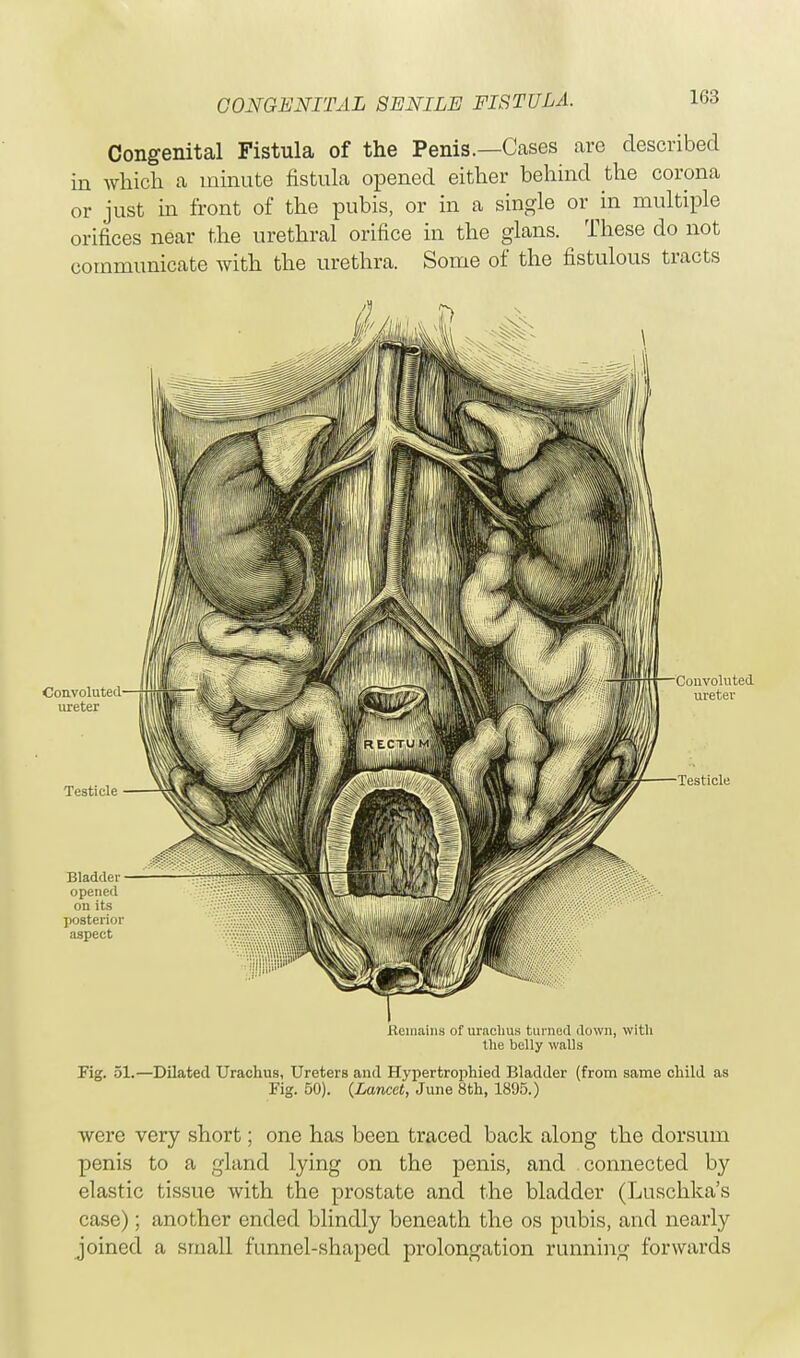 Congenital Fistula of the Penis.—Cases are described in which a minute fistula opened either behind the corona or just in front of the pubis, or in a single or in multiple orifices near the urethral orifice in the glans. These do not communicate with the urethra. Some of the fistulous tracts Remains of uraclius turned down, with the belly walls Fig. 51.—Dilated Uraclius, Ureters and Hypertrophied Bladder (from same child as Fig. 50). (Lancet, June 8th, 1895.) were very short; one has been traced back along the dorsum penis to a gland lying on the penis, and connected by elastic tissue with the prostate and the bladder (Luschka's case); another ended blindly beneath the os pubis, and nearly joined a small funnel-shaped prolongation running forwards