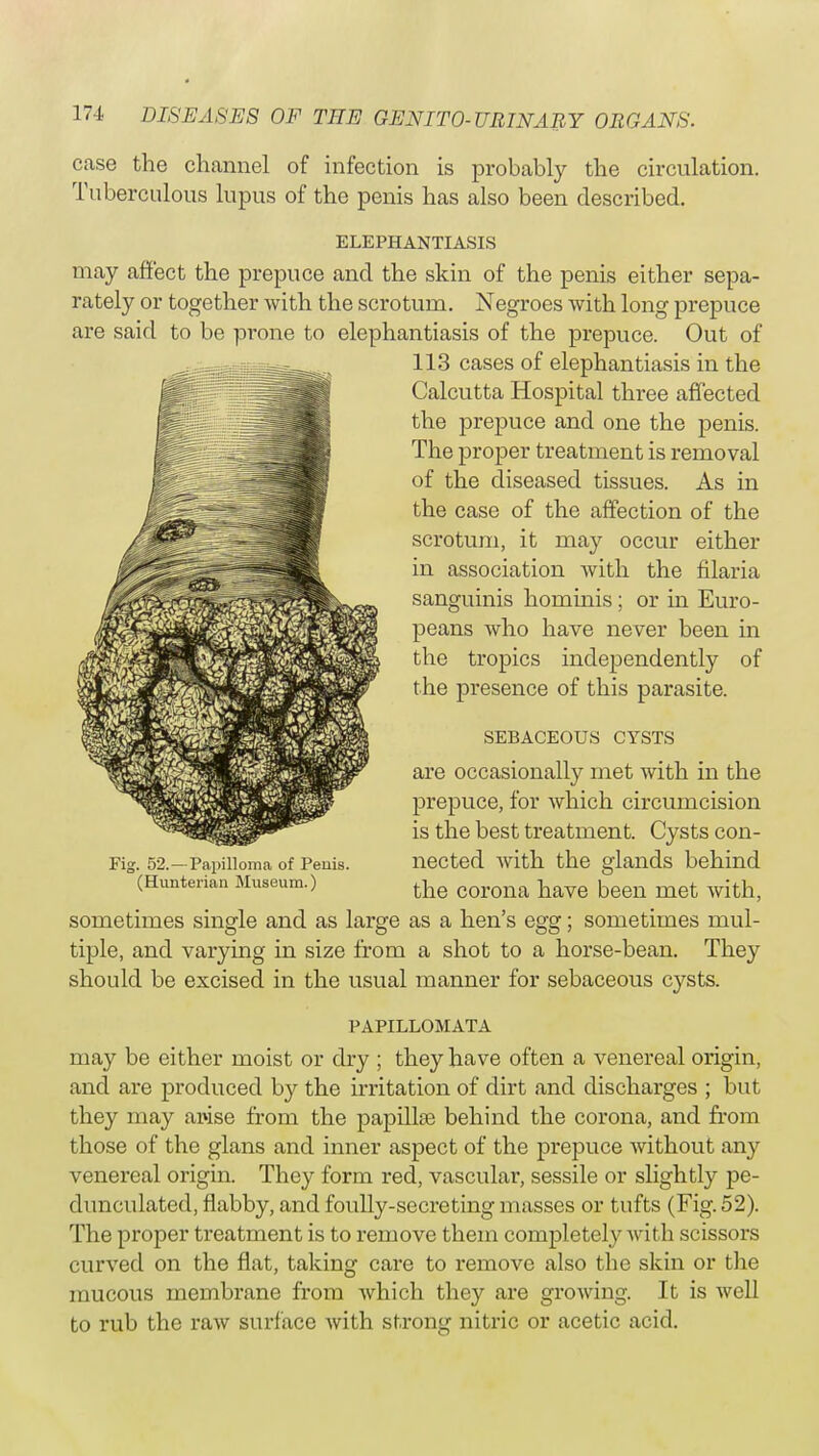 case the channel of infection is probably the circulation. Tuberculous lupus of the penis has also been described. ELEPHANTIASIS may affect the prepuce and the skin of the penis either sepa- rately or together with the scrotum. Negroes with long prepuce are said to be prone to elephantiasis of the prepuce. Out of 113 cases of elephantiasis in the Calcutta Hospital three affected the prepuce and one the penis. The proper treatment is removal of the diseased tissues. As in the case of the affection of the scrotum, it may occur either in association with the filaria sanguinis hominis; or in Euro- peans who have never been in the tropics independently of the presence of this parasite. SEBACEOUS CYSTS are occasionally met with in the prepuce, for which circumcision is the best treatment. Cysts con- Fig. 52.—Papilloma of Penis, nected with the glands behind (Hunterian Museum.) the C0TQJ1& have be(m me{. sometimes single and as large as a hen's egg; sometimes mul- tiple, and varying in size from a shot to a horse-bean. They should be excised in the usual manner for sebaceous cysts. PAPILLOMATA may be either moist or dry ; they have often a venereal origin, and are produced by the irritation of dirt and discharges ; but they may arise from the papillae behind the corona, and from those of the glans and inner aspect of the prepuce without any venereal origin. They form red, vascular, sessile or slightly pe- dunculated, flabby, and foully-secreting masses or tufts (Fig. 52). The proper treatment is to remove them completely with scissors curved on the flat, taking care to remove also the skin or the mucous membrane from which they are growing. It is well to rub the raw surface with strong nitric or acetic acid.