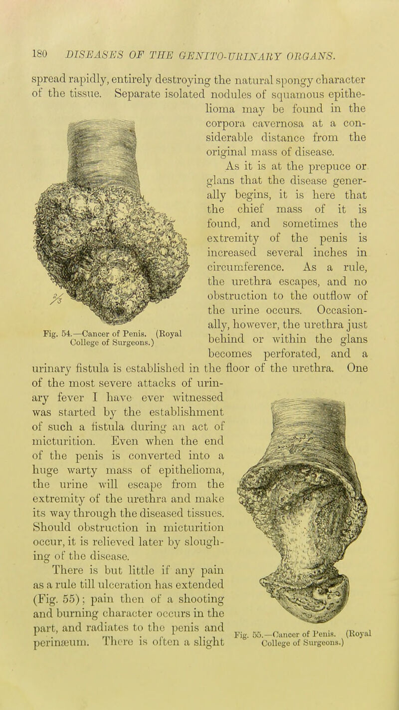 Fig. 54.—Cancer of Penis. (Royal College of Surgeons.) spread rapidly, entirely destroying the natural spongy character of the tissue. Separate isolated nodules of squamous epithe- lioma may be found in the corpora cavernosa at a con- siderable distance from the original mass of disease. As it is at the prepuce or glans that the disease gener- ally begins, it is here that the chief mass of it is found, and sometimes the extremity of the penis is increased several inches in circumference. As a rule, the urethra escapes, and no obstruction to the outflow of the urine occurs. Occasion- ally, however, the urethra just behind or within the glans becomes perforated, and a urinary fistula is established in the floor of the urethra. One of the most severe attacks of urin- ary fever I have ever witnessed was started by the establishment of such a fistula during an act of micturition. Even when the end of the penis is converted into a huge warty mass of epithelioma, the urine will escape from the extremity of the urethra and make its way through the diseased tissues. Should obstruction in micturition occur, it is relieved later by slough- ing of the disease. There is but little if any pain as a rule till ulceration has extended (Fig. 55); pain then of a shooting and burning character occurs in the part, and radiates to the penis and perineeum. There is often a slight Fig. 55.—Cancer of Penis. (Royal College of Surgeons.)