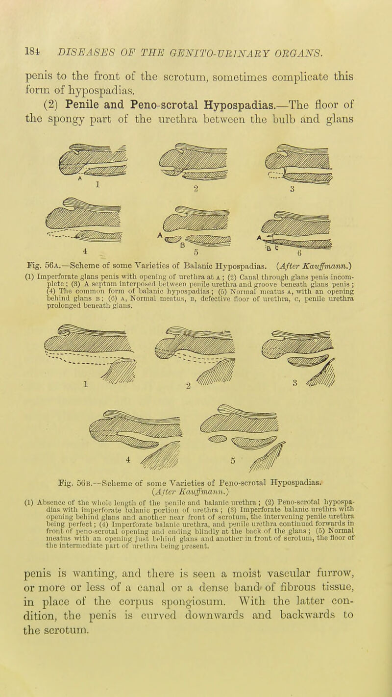 penis to the front of the scrotum, sometimes complicate this form of hypospadias. (2) Penile and Peno-scrotal Hypospadias.—The floor of the spongy part of the urethra between the bulb and glans Fig. 56a.—Scheme of some Varieties of Balanic Hypospadias. (After Kauffmann.) (1) Imperforate glans penis with opening of urethra at a ; (2) Canal through glans penis incom- plete ; (3) A septum interposed between penile urethra and groove beneath glans penis ; (4) The common form of balanic hypospadias; (5) Normal meatus a, with an opening behind glans b ; (6) a, Normal meatus, b, defective floor of urethra, c, penile urethra prolonged beneath glans. Fig. 56b.--Scheme of some Varieties of Peno-scrotal Hypospadias. (After Kaufman it.) (1) Absence of the whole length of the penile and balanic urethra ; (2) Peno-scrotal hypospa- dias with imperforate balanic portion of urethra; (8) Imperforate balanic urethra with opening behind glans and another near front of scrotum, the intervening penile urethra being perfect; (4) Imperforate balanic urethra, and penile urethra continued forwards in front of peno-scrotal opening and ending blindly at the back of the glans; (5) Normal meatus with an opening just behind glans and another in front of scrotum, the floor of the intermediate part of urethra being present. penis is wanting, and there is seen a moist vascular furrow, or more or less of a canal or a dense band' of fibrous tissue, in place of the corpus spongiosum. With the latter con- dition, the penis is curved downwards and backwards to the scrotum.