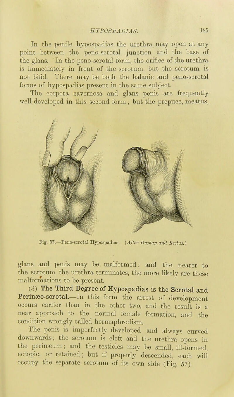 In the penile hypospadias the urethra may open at any point between the peno-scrotal junction and the base of the glans. In the peno-scrotal form, the orifice of the urethra is immediately in front of the scrotum, but the scrotum is not bifid. There may be both the balanic and peno-scrotal forms of hypospadias present in the same subject. The corpora cavernosa and glans penis are frequently well developed in this second form; but the prepuce, meatus, Fig. 57.— Pe:io-scrotal Hypospadias. {After Duplay and Rcclus.) glans and penis may be malformed; and the nearer to the scrotum the urethra terminates, the more likely are these malformations to be present. (3) The Third Degree of Hypospadias is the Scrotal and Perinseo-scrotal.—In this form the arrest of development occurs earlier than in the other two, and the result is a near approach to the normal female formation, and the condition wrongly called hermaphrodism. The penis is imperfectly developed and always curved downwards; the scrotum is cleft and the urethra opens in the perinasum; and the testicles may be small, ill-formed, ectopic, or retained; but if properly descended, each will occupy the separate scrotum of its own side (Fig. 57).