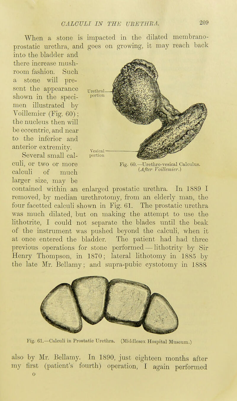 When a stone is impacted in the dilated membrano- prostatic urethra, and goes on growing, it may reach back into the bladder and there increase mush- room fashion. Such a stone will pre- sent the appearance shown in the speci- men illustrated by Voillemier (Fig. 60); the nucleus then will be eccentric, and near to the inferior and anterior extremity. Several small cal- culi, or two or more calculi of much larger size, may be contained within an enlarged prostatic urethra. In 1889 I removed, by median urethrotomy, from an elderly man, the four facetted calculi shown in Fig. 61. The prostatic urethra was much dilated, but on making the attempt to use the lithotrite, I could not separate the blades until the beak of the instrument was pushed beyond the calculi, when it at once entered the bladder. The patient had had three previous operations for stone performed — lithotrity by Sir Henry Thompson, in 1870; lateral lithotomy in 1885 by the late Mr. Bellamy; and supra-pubic cystotomy in 1888 Fig. 61.—Calculi in Prostatic Urethra. (Middlesex Hospital Museum.) also by Mr. Bellamy. In 1890, just eighteen months after my first (patient's fourth) operation, I again performed o