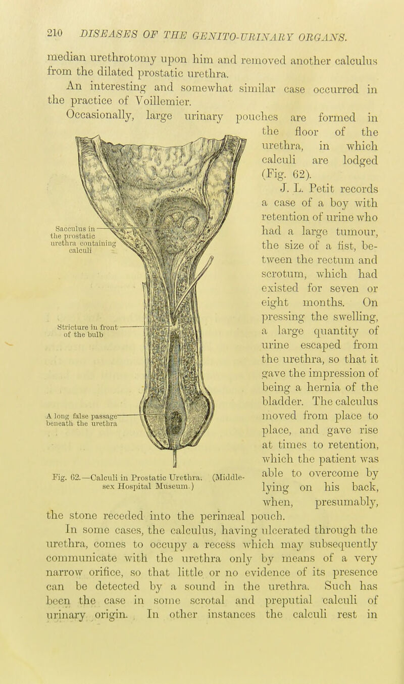 median urethrotomy upon him and removed another calculus from the dilated prostatic urethra. An interesting and somewhat similar case occurred in the practice of Voillemier. Occasionally, large urinary pouches are formed in the floor of the urethra, in which calculi are lodged (Fig. 62). J. L. Petit records a case of a boy with retention of urine who had a large tumour, the size of a fist, be- tween the rectum and scrotum, which had existed for seven or eight months. On pressing the swelling, a large quantity of urine escaped from the urethra, so that it gave the impression of being a hernia of the bladder. The calculus moved from place to place, and gave rise at times to retention, which the patient was Fig. 02.-Calculi in Prostatic Urethra. (Middle- abJe to Overcome by sex Hospital Museum.) lying on his back, when, presumably, the stone receded into the perinoeal pouch. In some cases, the calculus, having ulcerated through the urethra, comes to occupy a recess which ma}'' subsequently communicate with the urethra only by means of a very narrow orifice, so that little or no evidence of its presence can be detected by a sound in the urethra. Such has been the case in some scrotal and preputial calculi of urinary origin. In other instances the calculi rest in