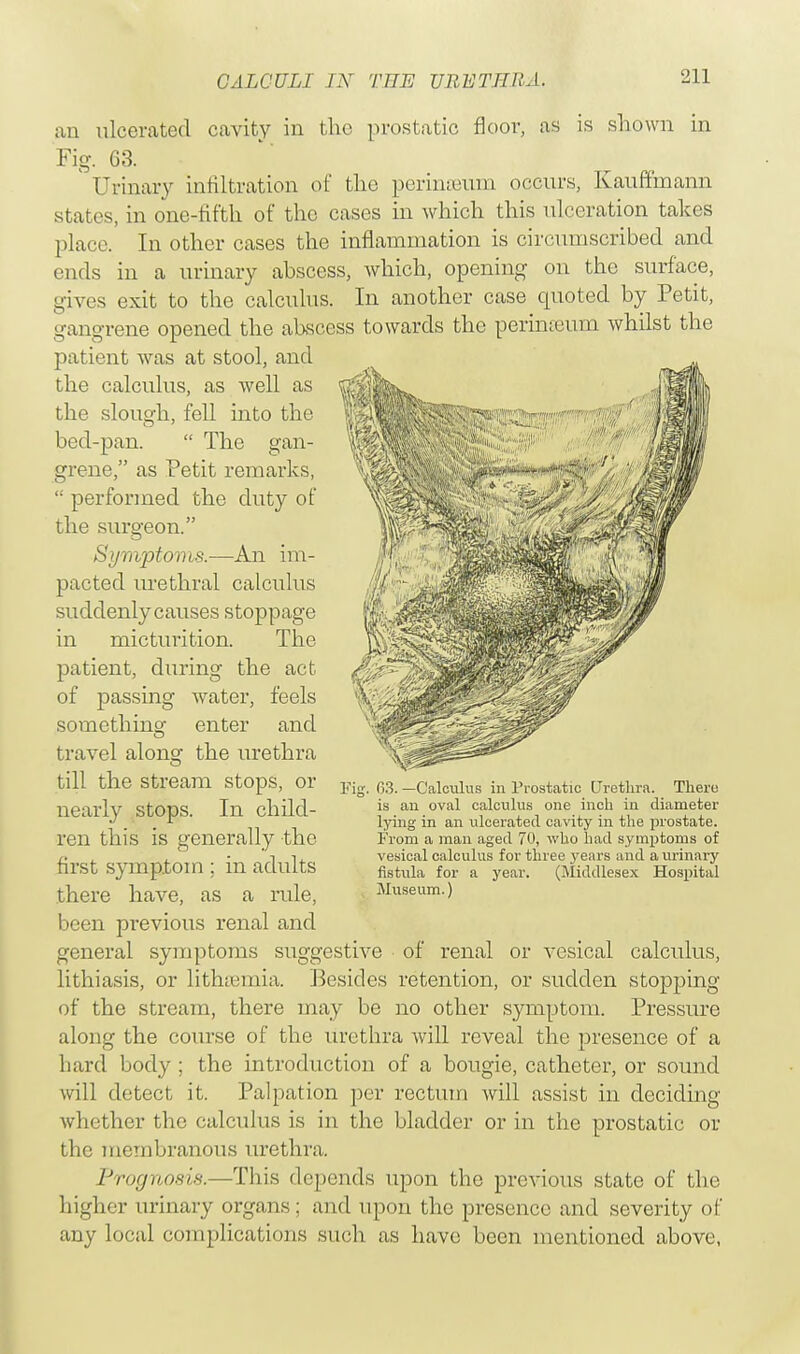 an ulcerated cavity in the prostatic floor, as is shown in Fig. 63. V Urinary infiltration of the perinoeum occurs, Kauffinann states, in one-fifth of the cases in which this ulceration takes place. In other cases the inflammation is circumscribed and ends in a urinary abscess, which, opening on the surface, gives exit to the calculus. In another case quoted by Petit, gangrene opened the abscess towards the perinEeum whilst the patient was at stool, and the calculus, as well as the slough, fell into the bed-pan.  The gan- grene, as Petit remarks,  performed the duty of the surgeon. Symptoms.—An im- pacted urethral calculus suddenly causes stoppage in micturition. The patient, during the act of passing water, feels something enter and travel along the urethra till the stream stops, or Yl„ nearly stops. In child- ren this is generally the first symptom ; in adults there have, as a rule, been previous renal and general symptoms suggestive of renal or vesical calculus, lithiasis, or lithsemia. Besides retention, or sudden stopping of the stream, there may be no other symptom. Pressure along the course of the urethra Avill reveal the presence of a hard body; the introduction of a bougie, catheter, or sound will detect it. Palpation per rectum will assist in deciding whether the calculus is in the bladder or in the prostatic or the membranous urethra. Prognosis.—This depends upon the previous state of the higher urinary organs; and upon the presence and severity of any local complications such as have been mentioned above, 63. —Calculus in Prostatic Urethra. There is an oval calculus one inch in diameter lying in an ulcerated cavity in the prostate. From a man aged 70, who had symptoms of vesical calculus for three years and a urinary fistula for a year. (Middlesex Hospital Museum.)