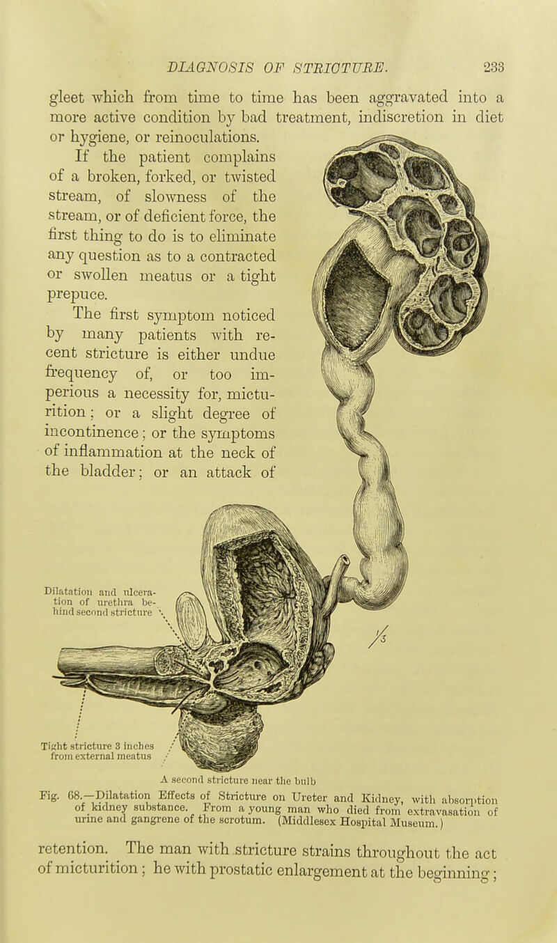 gleet which from time to time has been aggravated more active condition by bad treatment, indiscretion or hygiene, or reinoculations. If the patient complains of a broken, forked, or twisted stream, of slowness of the stream, or of deficient force, the first thing to do is to eliminate any question as to a contracted or swollen meatus or a tight prepuce. The first symptom noticed by many patients with re- cent stricture is either undue frequency of, or too im- perious a necessity for, mictu- rition ; or a slight degree of incontinence; or the symptoms of inflammation at the neck of the bladder; or an attack of into a in diet Dilatation and nlcera tion of urethra be hind second stricture light stricture 3 inches from external meatus A second stricture near the bulb Fig. G8.-Dilatation Effects of Stricture on Ureter and Kidney, with absorption of kidney substance. From a young man who died from extravasation of urine and gangrene of the scrotum. (Middlesex Hospital Museum.) retention. ^ The man with stricture strains throughout the act of micturition; he with prostatic enlargement at the beginning;