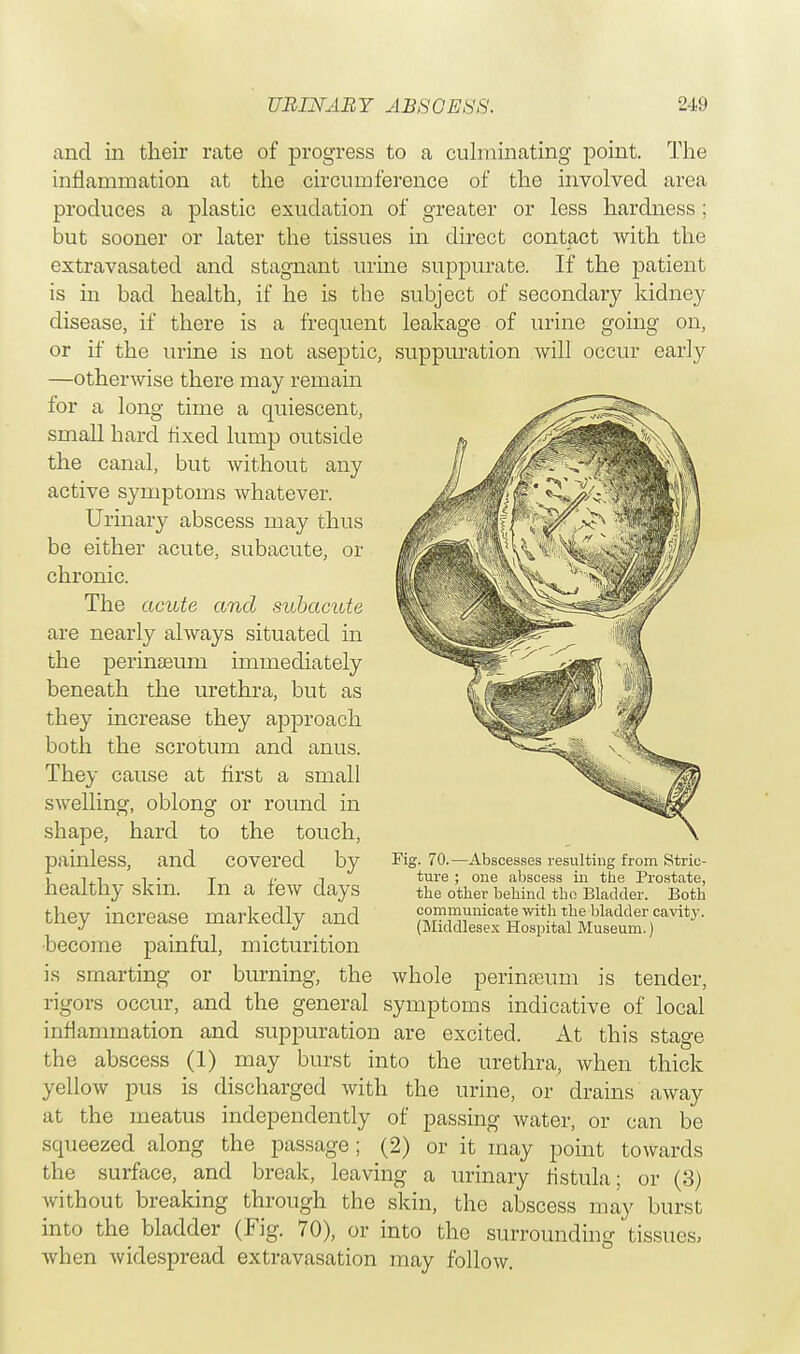 and in their rate of progress to a culminating point. The inflammation at the circumference of the involved area produces a plastic exudation of greater or less hardness ; but sooner or later the tissues in direct contact with the extravasated and stagnant urine suppurate. If the patient is in bad health, if he is the subject of secondary kidney disease, if there is a frequent leakage of urine going on, or if the urine is not aseptic, suppuration will occur early —otherwise there may remain for a long time a quiescent, small hard fixed lump outside the canal, but without any active symptoms whatever. Urinary abscess may thus be either acute, subacute, or chronic. The acute and subactrfe are nearly always situated in the perinseum immediately beneath the urethra, but as they increase they approach both the scrotum and anus. They cause at first a small swelling, oblong or round in shape, hard to the touch, painless, and covered by healthy skin. In a few days they increase markedly and •become painful, micturition is smarting or burning, the whole perinseum is tender, rigors occur, and the general symptoms indicative of local inflammation and suppuration are excited. At this stage the abscess (1) may burst into the urethra, when thick yellow pus is discharged with the urine, or drains away at the meatus independently of passing water, or can be squeezed along the passage; (2) or it may point towards the surface, and break, leaving a urinary fistula; or (3) without breaking through the skin, the abscess may burst into the bladder (Fig. 70), or into the surrounding tissues, when widespread extravasation may follow. Fig. 70. —Abscesses resulting from Stric- ture ; one abscess in the Prostate, the other behind the Bladder. Both communicate with the bladder cavity. (Middlesex Hospital Museum.)