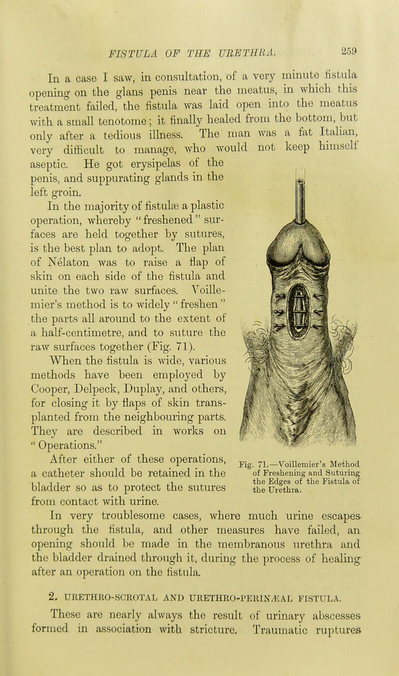 In a case I saw, in consultation, of a very minute fistula opening on the glans penis near the meatus, in which this treatment failed, the fistula was laid open into the meatus with a small tenotome; it finally healed from the bottom, but only after a tedious illness. The man was a fat Italian, very difficult to manage, who would not keep himself aseptic. He got erysipelas of the penis, and suppurating glands in the left groin. In the majority of fistulse a plastic operation, whereby  freshened  sur- faces are held together by sutures, is the best plan to adopt. The plan of Nelaton was to raise a flap of skin on each side of the fistula and unite the two raw surfaces. Voille- mier's method is to widely  freshen  the parts all around to the extent of a half-centimetre, and to suture the raw surfaces together (Fig. 71). When the fistula is wide, various methods have been employed by Cooper, Delpeck, Duplay, and others, for closing it by flaps of skin trans- planted from the neighbouring parts. They are described in works on  Operations. After either of these operations, a catheter should be retained in the bladder so as to protect the sutures from contact with urine. In very troublesome cases, where much urine escapes through the fistula, and other measures have failed, an opening should be made in the membranous urethra and the bladder drained through it, during the process of healing after an operation on the fistula. Fig. 71.—Voillemier's Method of Freshening and Suturing the Edges of the Fistula of the Urethra. 2. URETHRO-SCROTAL AND URETHRO-I'ERINyEAL FISTULA. These are nearly always the result of urinary abscesses formed in association with stricture. Traumatic ruptures