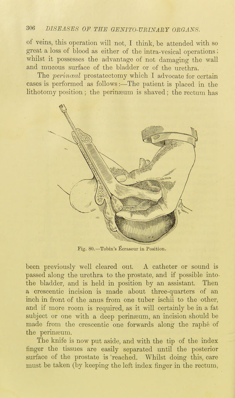 of veins, this operation will not, I think, be attended with so great a loss of blood as either of the intra-vesical operations; whilst it possesses the advantage of not damaging the wall and mucous surface of the bladder or of the urethra. The perincval prostatectomy which I advocate for certain cases is performed as follows:—The patient is placed in the lithotomy position ; the perinosum is shaved ; the rectum has Fig. 80.—Tobin's ficraseur in Position. been previously well cleared out. A catheter or sound is passed along the urethra to the prostate, and if possible into- the bladder, and is held in position by an assistant. Then a crescentic incision is made about three-quarters of an inch in front of the anus from one tuber ischii to the other, and if more room is required, as it will certainly be in a fat subject or one with a deep perinamm, an incision should be made from the crescentic one forwards along the raphe of the perinseuin. The knife is now put aside, and with the tip of the index finger the tissues are easily separated until the posterior surface of the prostate is 'reached. Whilst doing this, care must be taken (by keeping the left index finger in the rectum,