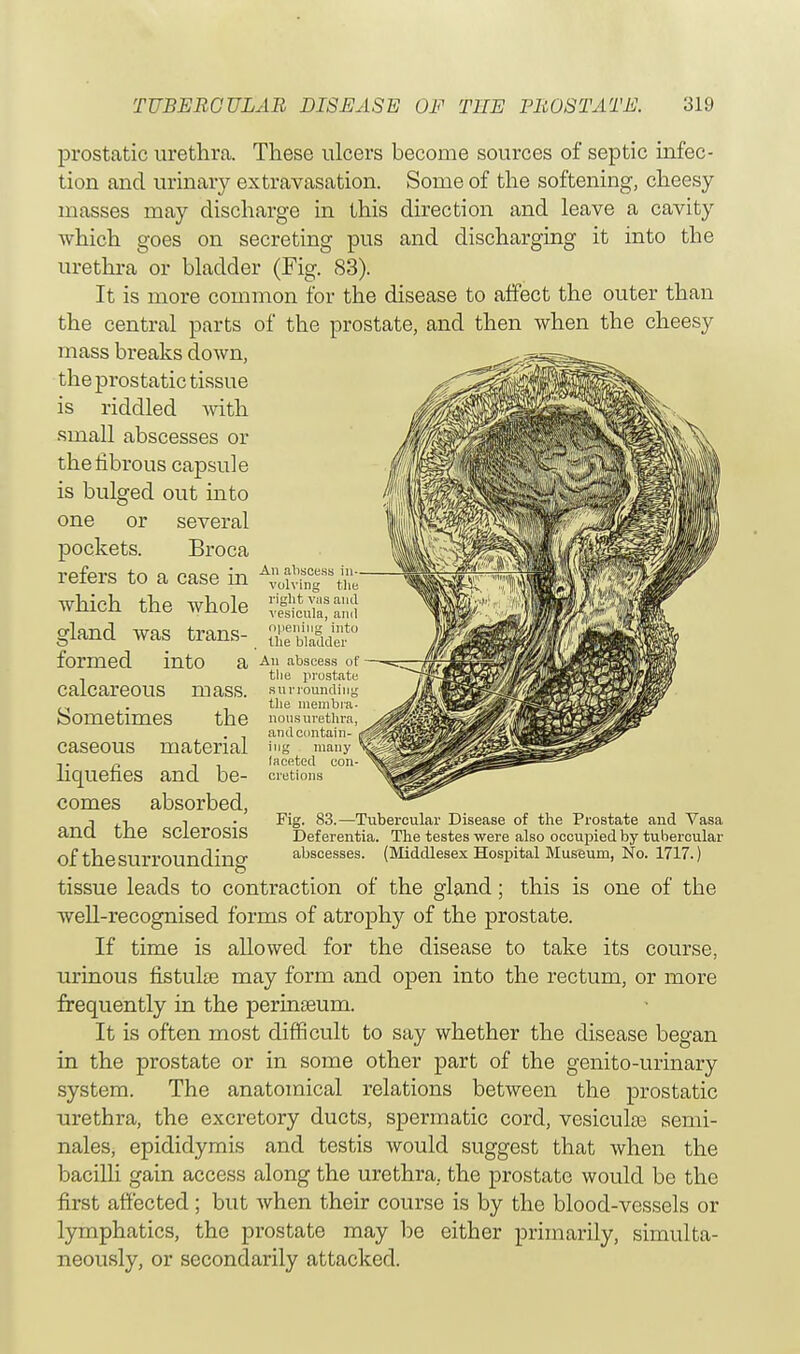prostatic urethra. These ulcers become sources of septic infec- tion and urinary extravasation. Some of the softening, cheesy masses may discharge in this direction and leave a cavity which goes on secreting pus and discharging it into the urethra or bladder (Fig. S3). It is more common for the disease to affect the outer than the central parts of* the prostate, and then when the cheesy mass breaks down, the prostatic tissue is riddled with small abscesses or the fibrous capsule is bulged out into one or several pockets. Broca refers to a case in A;Vws%t Which the Whole ^cul'and gland was trans- formed into calcareous mass. Sometimes the caseous material liquefies and be- comes absorbed, and the sclerosis of the surrounding1 opening into Hie bladder a, An abscess of the prostate surrounding the membra- nous urethra and contain- ing many laceted con cretions Fig. 83.—Tubercular Disease of the Prostate and Vasa Def erentia. The testes were also occupied by tubercular abscesses. (Middlesex Hospital Museum, No. 1717.) tissue leads to contraction of the gland; this is one of the well-recognised forms of atrophy of the prostate. If time is allowed for the disease to take its course, urinous fistulse may form and open into the rectum, or more frequently in the perinseum. It is often most difficult to say whether the disease began in the prostate or in some other part of the genito-urinary system. The anatomical relations between the prostatic urethra, the excretory ducts, spermatic cord, vesicular semi- nales, epididymis and testis would suggest that when the bacilli gain access along the urethra, the prostate would be the first affected; but when their course is by the blood-vessels or lymphatics, the prostate may be either primarily, simulta- neously, or secondarily attacked.