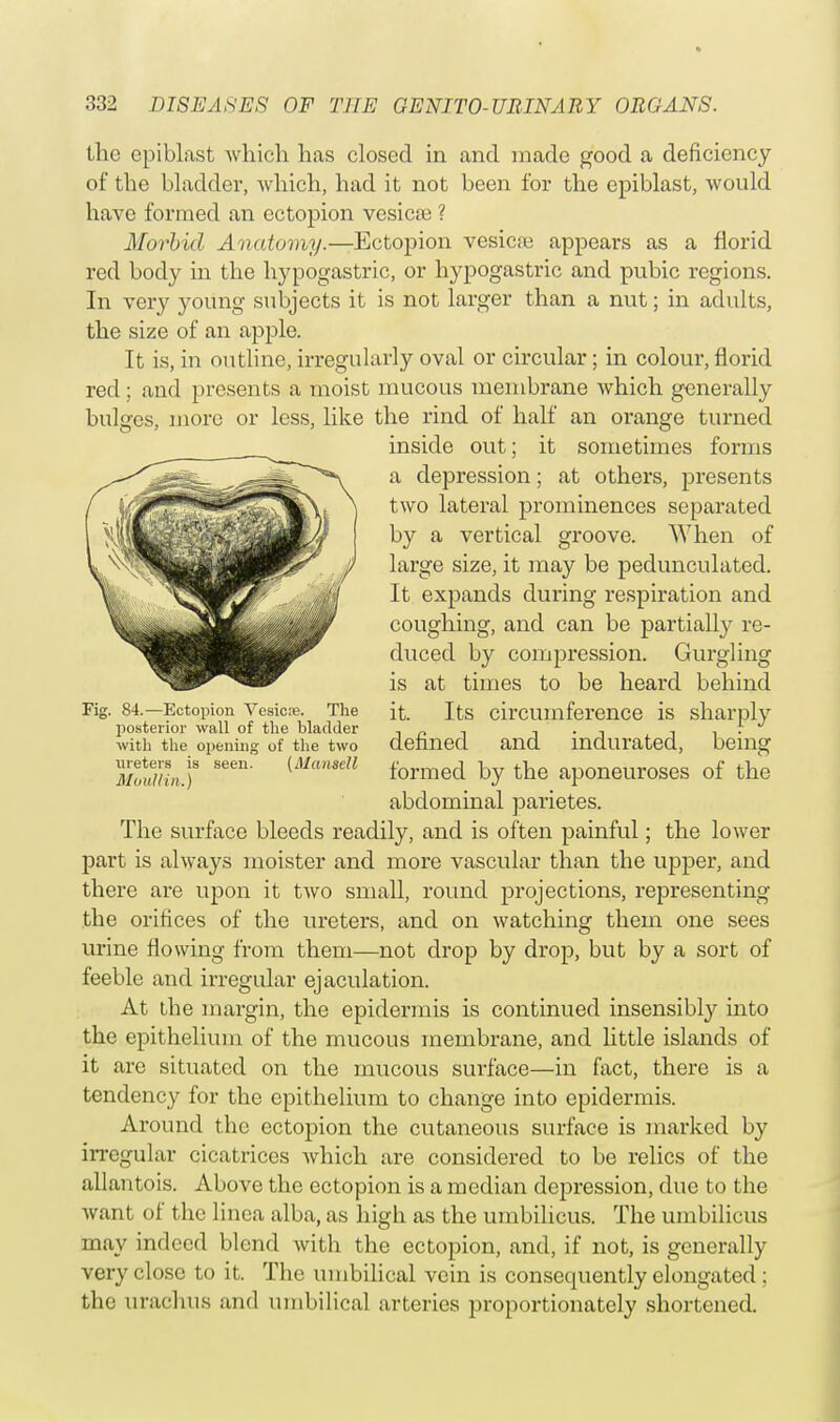 the epiblast which has closed in and made good a deficiency of the bladder, Avhich, had it not been for the epiblast, would have formed an ectopion vesicae ? Morbid Anatomy.— Ectopion vesica? appears as a florid red body in the hypogastric, or hypogastric and pubic regions. In very young subjects it is not larger than a nut; in adults, the size of an apple. It is, in outline, irregularly oval or circular; in colour, florid red; and presents a moist mucous membrane which generally bulges, more or less, like the rind of half an orange turned inside out; it sometimes forms a depression; at others, presents two lateral prominences separated by a vertical groove. When of large size, it may be pedunculated. It expands during respiration and coughing, and can be partially re- duced by compression. Gurgling is at times to be heard behind it. Its circumference is sharply defined and indurated, being formed by the aponeuroses of the abdominal parietes. The surface bleeds readily, and is often painful; the lower part is always moister and more vascular than the upper, and there are upon it two small, round projections, representing the orifices of the ureters, and on watching them one sees urine flowing from them—not drop by drop, but by a sort of feeble and irregular ejaculation. At the margin, the epidermis is continued insensibly into the epithelium of the mucous membrane, and little islands of it are situated on the mucous surface—in fact, there is a tendency for the epithelium to change into epidermis. Around the ectopion the cutaneous surface is marked by irregular cicatrices which are considered to be relics of the allantois. Above the ectopion is a median depression, due to the want of the liuca alba, as high as the umbilicus. The umbilicus may indeed blend with the ectopion, and, if not, is generally very close to it. The umbilical vein is consequently elongated : the urachus and umbilical arteries proportionately shortened. Fig. 84.—Ectopion Vesicre. The posterior wall of the bladder with the opening of the two ureters is seen. (Mansell MouUin.)
