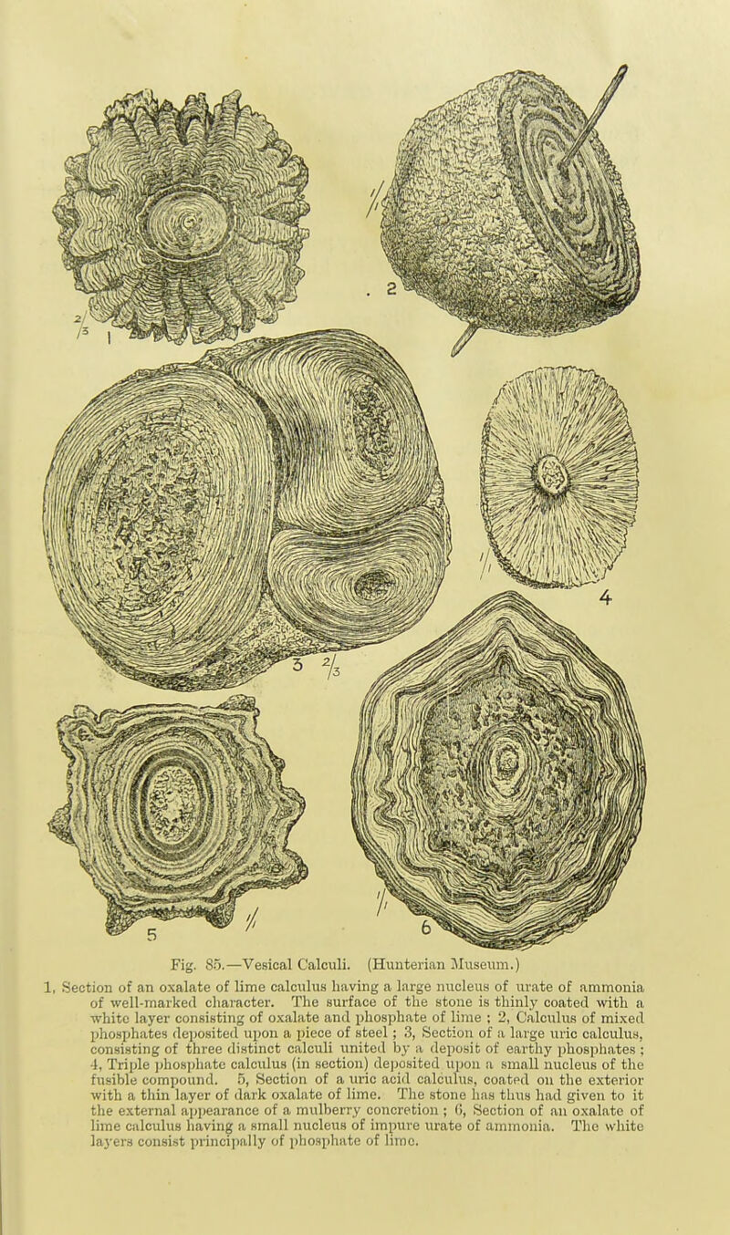 Fig. 85.—Vesical Calculi. (Hunterian Museum.) 1, Section of an oxalate of lime calculus having a large nucleus of urate of ammonia of well-marked character. The surface of the stone is thinly coated with a white layer consisting of oxalate and phosphate of lime ; 2, Calculus of mixed phosphates deposited upon a piece of steel; 3, Section of a large uric calculus, consisting of three distinct calculi united b}- a deposit of earthy phosphates : 4, Triple phosphate calculus (in section) deposited upon a small nucleus of the fusible compound. 5, Section of a uric acid calculus, coated on the exterior with a thin layer of dark oxalate of lime. The stone has thus had given to it the external appearance of a mulberry concretion ; G, Section of an oxalate of lime calculus having a small nucleus of impure urate of ammonia. The white layers consist principally of phosphate of lime.