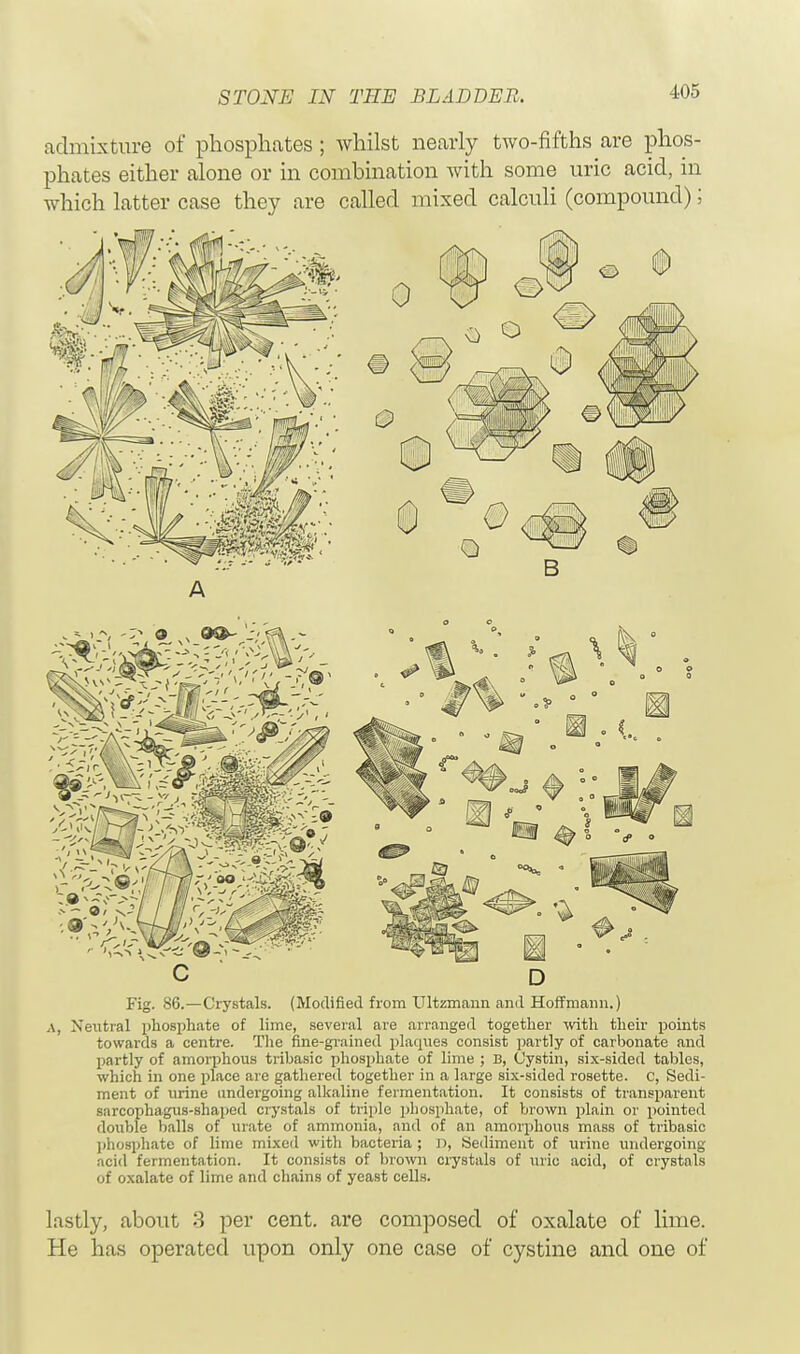 admixture of phosphates ; whilst nearly two-fifths are phos- phates either alone or in combination with some uric acid, in which latter case they are called mixed calculi (compound); A Fig. 86.—Crystals. (Modified from Ultzmann and Hoffmann.) A, Neutral phosphate of lime, several are arranged together with their points towards a centre. The fine-grained plaques consist partly of carbonate and partly of amorphous tribasic phosphate of lime ; B, Cystin, six-sided tables, which in one place are gathered together in a large six-sided rosette, c, Sedi- ment of urine undergoing alkaline fermentation. It consists of transparent sarcophagus-shaped crystals of triple phosphate, of brown plain or pointed double balls of urate of ammonia, and of an amorphous mass of tribasic phosphate of lime mixed with bacteria; D, Sediment of urine undergoing acid fermentation. It consists of brown crystals of uric acid, of crystals of oxalate of lime and chains of yeast cells. lastly, about 3 per cent, are composed of oxalate of lime. He has operated upon only one case of cystine and one of