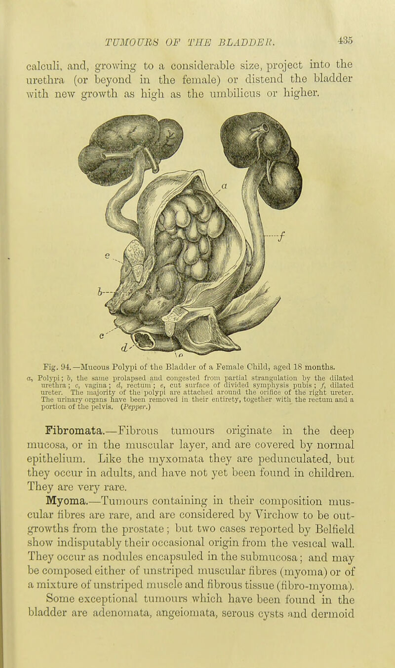 calculi, and, growing to a considerable size, project into the urethra (or beyond in the female) or distend the bladder with new growth as high as the umbilicus or higher. Fig. 94.—Mucous Polypi of the Bladder of a Female Child, aged 18 months. a, Polypi; 6, the same prolapsed aud congested from partial strangulation by the dilated urethra; c, vagina; d, rectum ; e, cut surface of divided symphysis pubis ; /, dilated ureter. The majority of the polypi are attached around the oritice of the right ureter. The urinary organs have been removed in their entirety, together with the rectum and a portion of the pelvis. {Pepper.) Fibromata.—Fibrous tumours originate in the deep mucosa, or in the muscular layer, and are covered by normal epithelium. Like the myxomata they are pedunculated, but they occur in adults, and have not yet been found in children. They are very rare. Myoma.—Tumours containing in their composition mus- cular fibres are rare, and are considered by Virchow to be out- growths from the prostate; but two cases reported by Belfield show indisputably their occasional origin from the vesical wall. They occur as nodules encapsuled in the submucosa; and may be composed either of unstriped muscular fibres (myoma) or of a mixture of unstriped muscle and fibrous tissue (fibro-myoma). Some exceptional tumours which have been found in the bladder are adenomata, angeiomata, serous cysts and dermoid