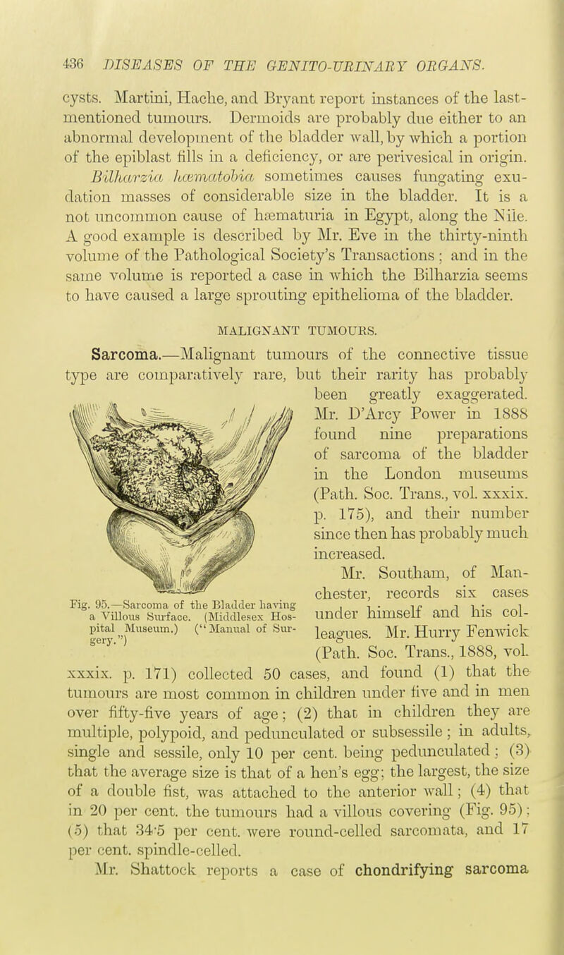 cysts. Martini, Hache, and Bryant report instances of the last- mentioned tumours. Dermoids are probably due either to an abnormal development of the bladder wall, by which a portion of the epiblast fills in a deficiency, or are perivesical in origin. Bilharzia hcematobia sometimes causes fungating exu- dation masses of considerable size in the bladder. It is a not uncommon cause of hsematuria in Egypt, along the Nile. A good example is described by Mr. Eve in the thirty-ninth volume of the Pathological Society's Transactions ; and in the same volume is reported a case in which the Bilharzia seems to have caused a large sprouting epithelioma of the bladder. MALIGNANT TUMOURS. Sarcoma.—Malignant tumours of the connective tissue t}'pe are comparatively rare, but their rarity has probably been greatly exaggerated. Mr. D'Arcy Power in 1888 found nine preparations of sarcoma of the bladder in the London museums (Path. Soc. Trans., vol. xxxix. p. 175), and their number since then has probably much increased. Mr. Southam, of Man- chester, records six cases Fig. 95.—Sarcoma of the Bladder having , ■, . lr j i • l a Villous Surface. (Middlesex Hos- Under himself and illS COl- pital Museum.) (Manual of Sur- ieaglies. Mr. Hurry Fenwick (Path. Soc. Trans., 1888, vol. xxxix. p. 171) collected 50 cases, and found (1) that the tumours are most common hi children under five and in men over fifty-five years of age; (2) that in children they are multiple, polypoid, and pedunculated or subsessile ; in adults, single and sessile, only 10 per cent, being pedunculated; (3) that the average size is that of a hen's egg; the largest, the size of a double fist, was attached to the anterior wall; (4) that in 20 per cent, the tumours had a villous covering (Fig. 95): (5) that 34-5 per cent, were round-celled sarcomata, and 17 per cent, spindle-celled. Mr. Shattoek reports a case of chondrifying sarcoma