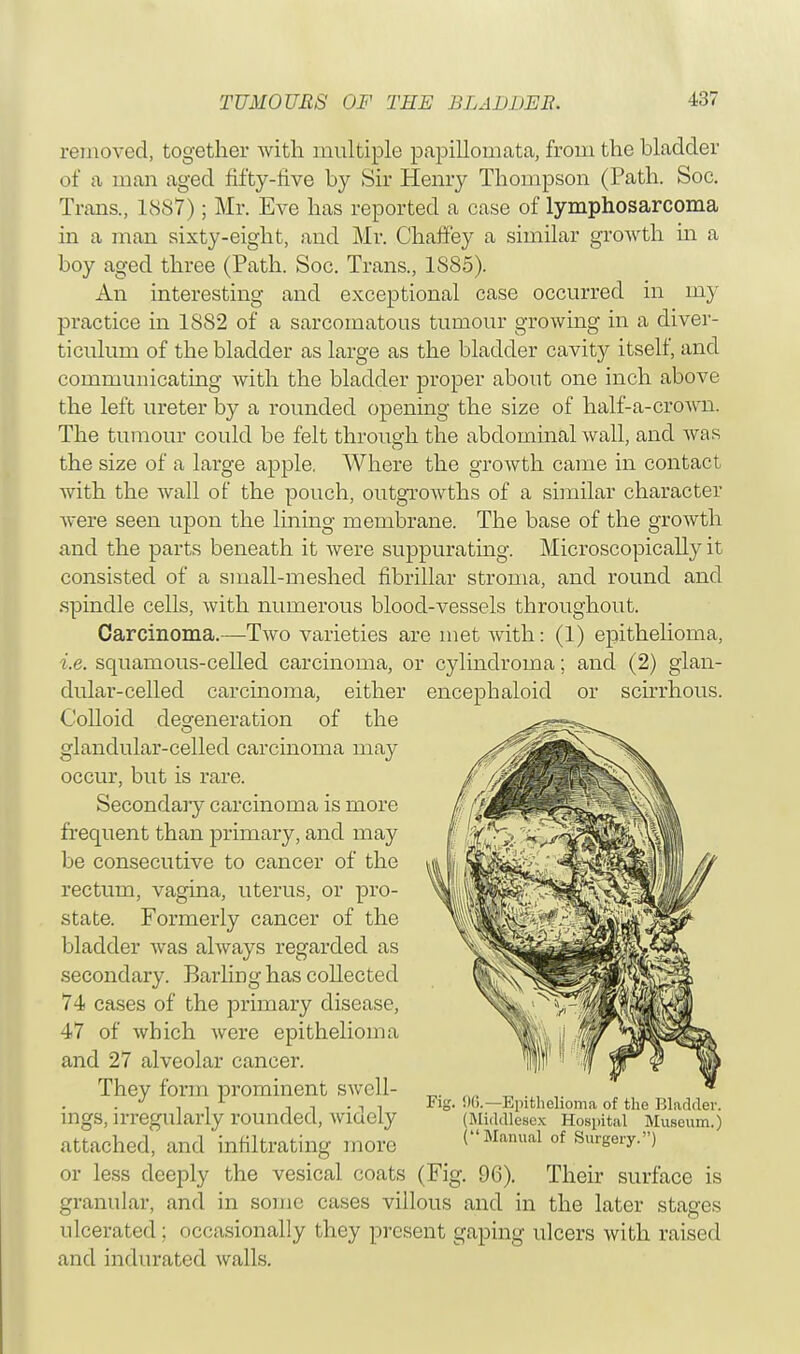 removed, together with multiple papillomata, from the bladder of a man aged fifty-five by Sir Henry Thompson (Path. Soc. Trans., 1887); Mr. Eve has reported a case of lymphosarcoma in a man sixty-eight, and Mr. Chaffey a similar groAvth in a boy aged three (Path. Soc. Trans., 1S85). An interesting and exceptional case occurred in my practice in 1SS2 of a sarcomatous tumour growing in a diver- ticulum of the bladder as large as the bladder cavity itself, and communicating with the bladder proper about one inch above the left ureter by a rounded opening the size of half-a-crown. The tumour could be felt through the abdominal wall, and was the size of a large apple. Where the growth came in contact with the wall of the pouch, outgrowths of a similar character were seen upon the lining membrane. The base of the growth and the parts beneath it were suppurating. Microscopically it consisted of a small-meshed fibrillar stroma, and round and spindle cells, with numerous blood-vessels throughout. Carcinoma.—Two varieties are met with: (1) epithelioma, i.e. squamous-celled carcinoma, or cylindroma; and (2) glan- dular-celled carcinoma, either encephaloid or scirrhous. Colloid defeneration of the glandular-celled carcinoma may occur, but is rare. Secondary carcinoma is more frequent than primary, and may be consecutive to cancer of the rectum, vagina, uterus, or pro- state. Formerly cancer of the bladder was always regarded as secondary. Barling has collected 74 cases of the primary disease, 47 of which were epithelioma and 27 alveolar cancer. They form prominent swell- ings, irregularly rounded, widely attached, and infiltrating more or less deeply the vesical coats (Fig. 96). Their surface is granular, and in some cases villous and in the later stages ulcerated; occasionally they present gaping ulcers with raised and indurated walls. Fig. 96.— Epithelioma of the Bladder. (Middlesex Hospital Museum.) (Manual of Surgery.)