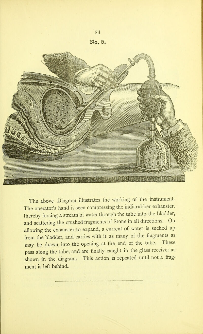 The above Diagram illustrates the working of the instrument. The operator's hand is seen compressing the indiarubber exhauster, thereby forcing a stream of water through the tube into the bladder, and scatteiing the crushed fragments of Stone in all directions. On allowing the exhauster to expand, a current of water is sucked up from the bladder, and carries with it as many of the fragments as may be drawn into the opening at the end of the tube. These pass along the tube, and are finally caught in the glass receiver as shown in the diagram. This action is repeated until not a frag- ment is left behind.