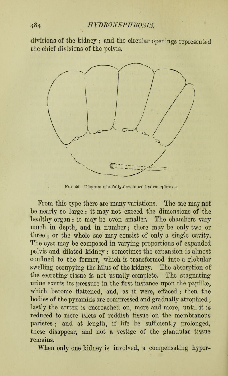 divisions of the kidney ; and the circular openings represented the chief divisions of the pelvis. Fig. 60. Diagram of a fully-developed hydronephiosis. From this type there are many variations. The sac may not be nearly so large : it may not exceed the dimensions of the healthy organ : it may be even smaller. The chambers vary much in depth, and in number; there may be only two or three ; or the whole sac may consist of only a single cavity. The cyst may be composed in varying proportions of expanded pelvis and dilated kidney : sometimes the expansion is almost confined to the former, which is transformed into a globular swelling occupying the hilus of the kidney. The absorption of the secreting tissue is not usually complete. The stagnating urine exerts its pressure in the first instance upon the papillae, which become flattened, and, as it were, effaced ; then the bodies of the pyramids are compressed and gradually atrophied; lastly the cortex is encroached on, more and more, until it is reduced to mere islets of reddish tissue on the membranous parietes; and at length, if life be sufliciently prolonged, these disappear, and not a vestige of the glandular tissue remains. When only one kidney is involved, a compensating hyper-