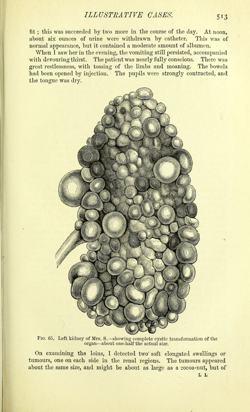 fit ; this was succeeded by two more in the course of the day. At noon, about six ounces of urine were withdrawn by catheter. This was of normal appearance, but it contained a moderate amount of albumen. When I saw her in the evening, the vomiting still persisted, accompanied with devouring thirst. The patient was nearly fully conscious. There was great restlessness, with tossing of the limbs and moaning. The bowels had been opened by injection. The pupils were strongly contracted, and the tongue was dry. Fig. 65. Left kidney of Mrs. S. —showing complete cystic transformation of the organ—about one-half the actual size. On examining the loins, I detected two soft elongated swellings or- tumours, one on each side in the renal regions. The tumours appeared about the same size, and might be about as large as a cocoa-nut, but of L L