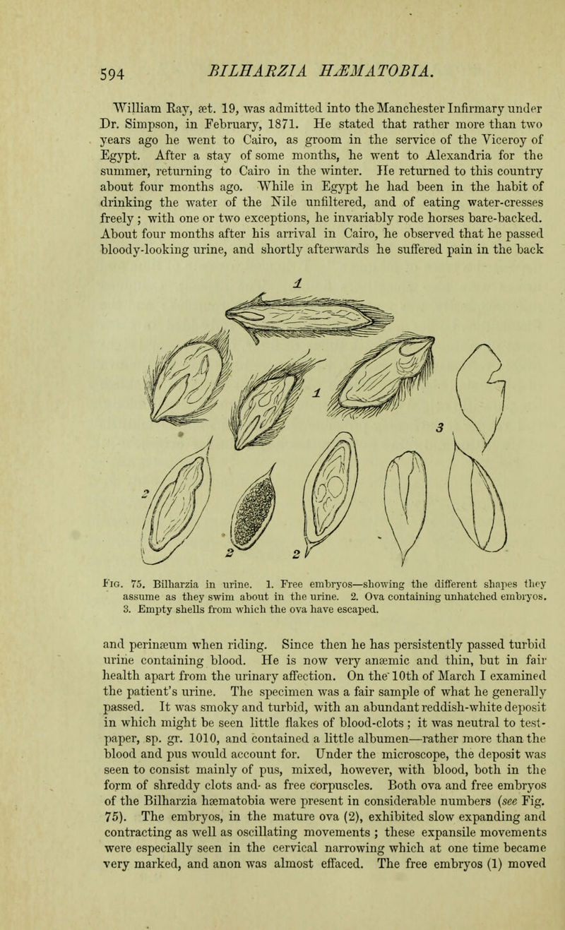 William Ray, set. 19, was admitted into the Manchester Infirmary under Dr. Simpson, in February, 1871. He stated that rather more than two years ago he went to Cairo, as groom in the service of the Viceroy of Egypt. After a stay of some months, he went to Alexandria for the summer, retui'ning to Cairo in the winter. He returned to this country about four months ago. While in Egypt he had been in the habit of drinking the water of the Nile unfiltered, and of eating water-cresses freely ; with one or two exceptions, he invariably rode horses bare-backed. About four months after his arrival in Cairo, he observed that he passed bloody-looking urine, and shortly afterwards he suffered pain in the back f'lG. 75. Billiarzia in urine. 1. Free embryos—showing the different shapes they assume as they swim about in the urine. 2. Ova containing unhatched embryos. 3. Empty shells from which the ova have escaped. and perinseum when riding. Since then he has persistently passed turbid urine containing blood. He is now very ansemic and thin, but in fair health apart from the urinary affection. On the 10th of March I examined the patient's urine. The specimen was a fair sample of what he generally passed. It was smoky and turbid, with an abundant reddish-white deposit in which might be seen little flakes of blood-clots ; it was neutral to test- paper, sp. gr. 1010, and contained a little albumen—rather more than the blood and pus would account for. Under the microscope, the deposit was seen to consist mainly of pus, mixed, however, with blood, both in the form of shreddy clots and- as free corpuscles. Both ova and free embryos of the Bilharzia hsematobia were present in considerable numbers {see Fig. 75). The embryos, in the mature ova (2), exhibited slow expanding and contracting as well as oscillating movements ; these expansile movements were especially seen in the cervical narrowing which at one time became very marked, and anon was almost efi'aced. The free embryos (1) moved