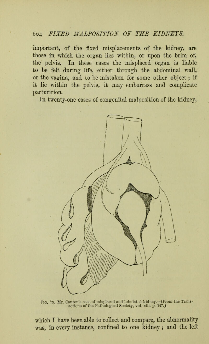 important, of the fixed misplacements of the kidney, are those in which the organ lies within, or upon the brim of, the pelvis. In these cases the misplaced organ is liable to be felt during life, either through the abdominal wall, or the vagina, and to be mistaken for some other object; if it lie within the pelvis, it may embarrass and complicate parturition. In twenty-one cases of congenital malposition of the kidney, Fig. 79. Mr. Canton's case of misplaced and lobulated kidney.—(From the Trans- actions of the Pathological Society, vol. xiii. p. 147.) which I have been able to collect and compare, the abnormality was, in every instance, confined to one kidney ; and the left