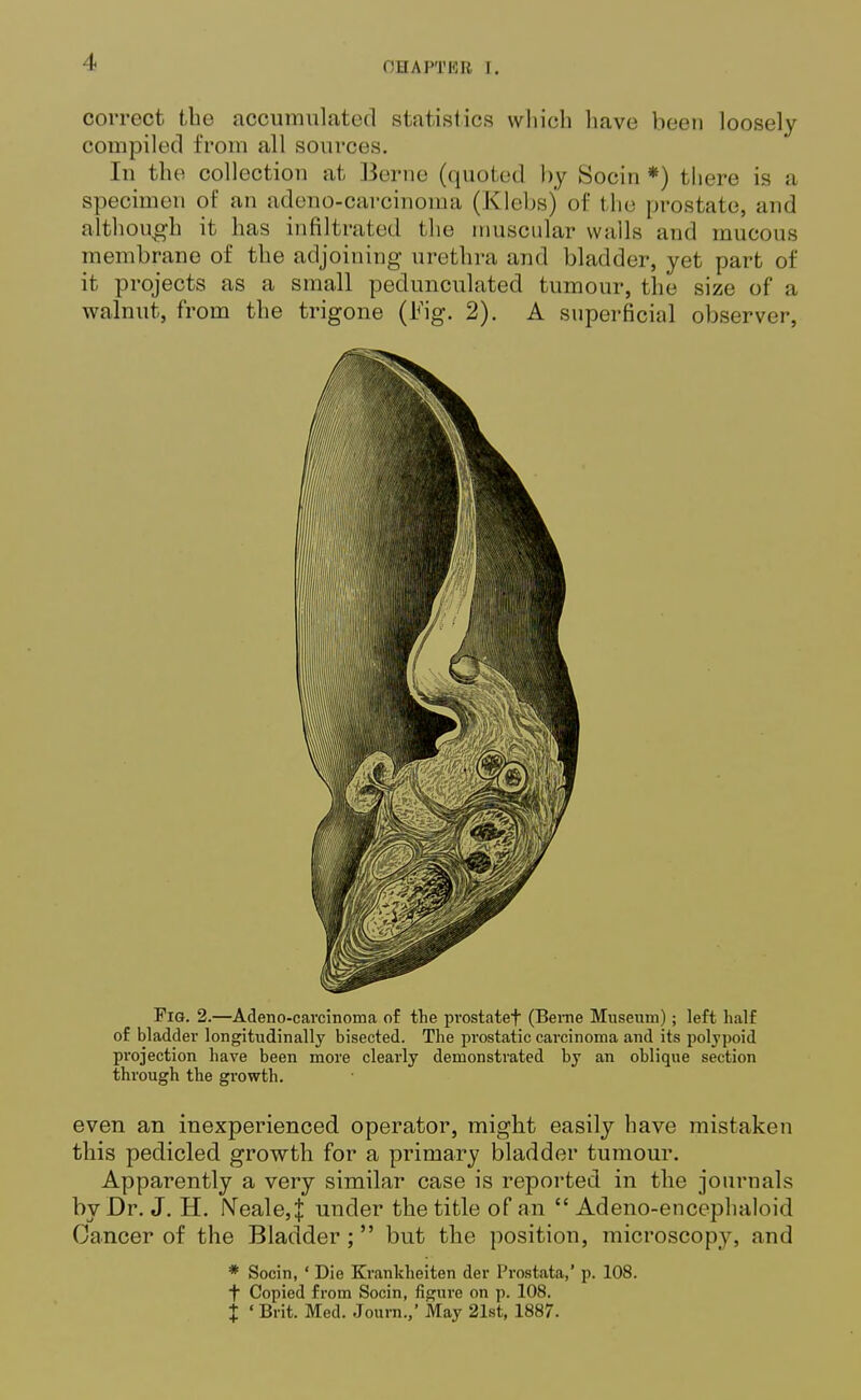 correct tbe accumulated statistics which have been loosely compiled from all sources. In the collection at Berne (quoted by Socin *) there is a specimen of an adeno-carcinoma (Klebsj of the prostate, and although it has infiltrated the muscular wails and mucous membrane of the adjoining urethra and bladder, jrel part of it projects as a small pedunculated tumour, the size of a walnut, from the trigone (Fig. 2). A superficial observer, Fig. 2.—Adeno-carcinoma of the prostatef (Beme Museum); left half of bladder longitudinally bisected. The prostatic carcinoma and its polypoid projection have been more clearly demonstrated by an oblique section through the growth. even an inexperienced operator, might easily have mistaken this pedicled growth for a primary bladder tumour. Apparently a very similar case is reported in the journals by Dr. J. H. lVeale,J under the title of an  Adeno-encephaloid Cancer of the Bladder ;  but the position, microscopy, and * Socin, ' Die Krankheiten der Prostata,' p. 108. t Copied from Socin, figure on p. 108. X ' Brit. Med. Journ.,' May 21st, 1887.