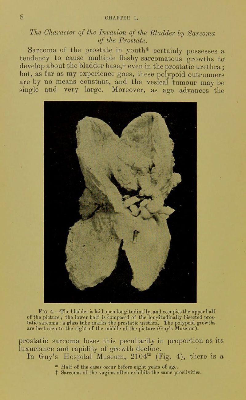 The Character of the Invasion of the Bladder by Sarcoma of the Prostate. Sarcoma of the prostate in youth* certainly possesses a tendency to cause multiple fleshy sarcomatous growths to develop about the bladder base,f even in the prostatic urethra; but, as far as my experience goes, these polypoid outrunners are by no means constant, and the vesical tumour may be single and very large. Moreover, as age advances the Fig. 4.—The bladder is laid open longitudinally, and occupies the upper half of the picture ; the lower half is composed of the longitudinally bisected pros- tatic sarcoma: a glass tube marks the prostatic urethra. The polypoid growths are best seen to the'right of the middle of the picture (Guy's Museum). prostatic sarcoma loses this peculiarity in proportion as its luxuriance and rapidity of growth decline. In Guy's Hospital Museum, 210482 (Fig. 4), there is a * Half of the cases occur before eight years of age. f Sarcoma of the vagina often exhibits the same proclivities.
