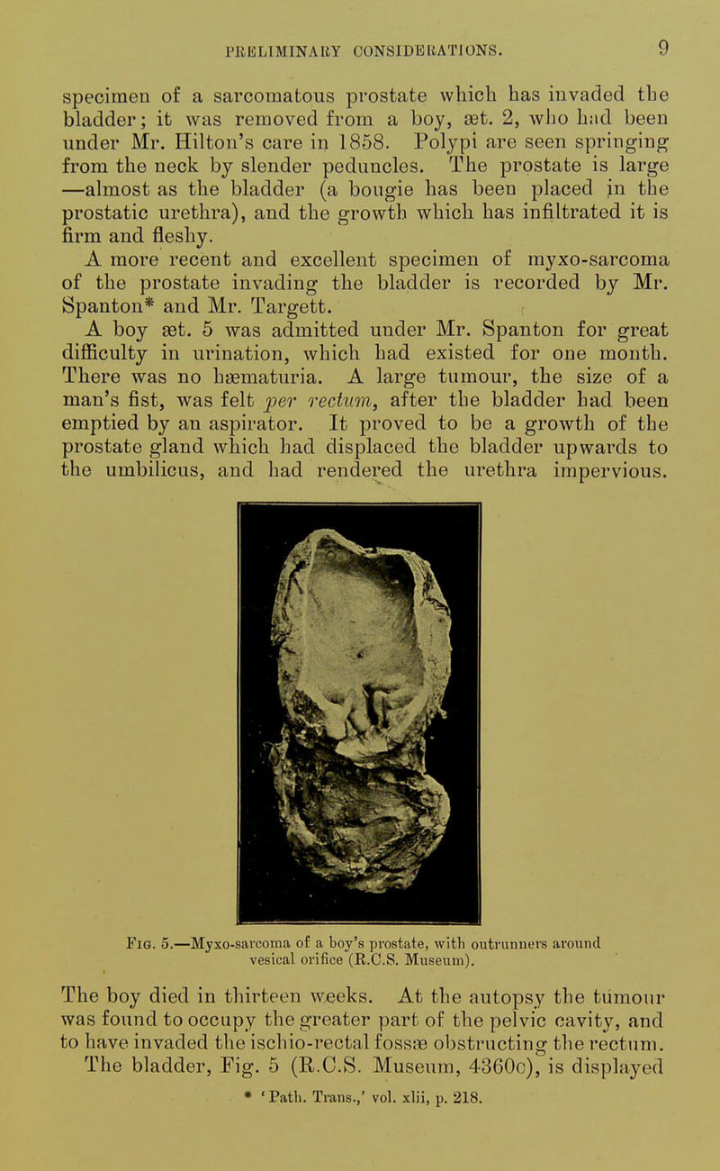 specimen of a sarcomatous prostate which has invaded the bladder; it was removed from a boy, aet. 2, who h:id been under Mr. Hilton's care in 1858. Polypi are seen springing from the neck by slender peduncles. The prostate is large —almost as the bladder (a bougie has been placed in the prostatic urethra), and the growth which has infiltrated it is firm and fleshy. A more recent and excellent specimen of myxo-sarcoma of the prostate invading the bladder is recorded by Mr. Spanton* and Mr. Targett. A boy set. 5 was admitted under Mr. Spanton for great difficulty in urination, which had existed for one month. There was no hamiaturia. A large tumour, the size of a man's fist, was felt per rectum, after the bladder had been emptied by an aspirator. It proved to be a growth of the prostate gland which had displaced the bladder upwards to the umbilicus, and had rendered the urethra impervious. Fig. 5.—Myxo-sarcoma of a boy's prostate, with outrunners around vesical orifice (R.C.S. Museum). The boy died in thirteen weeks. At the autopsy the tumour was found to occupy the greater part of the pelvic cavity, and to have invaded the ischio-rectal fossse obstructing the rectum. The bladder, Fig. 5 (R.C.S. Museum, 4360c), is displayed