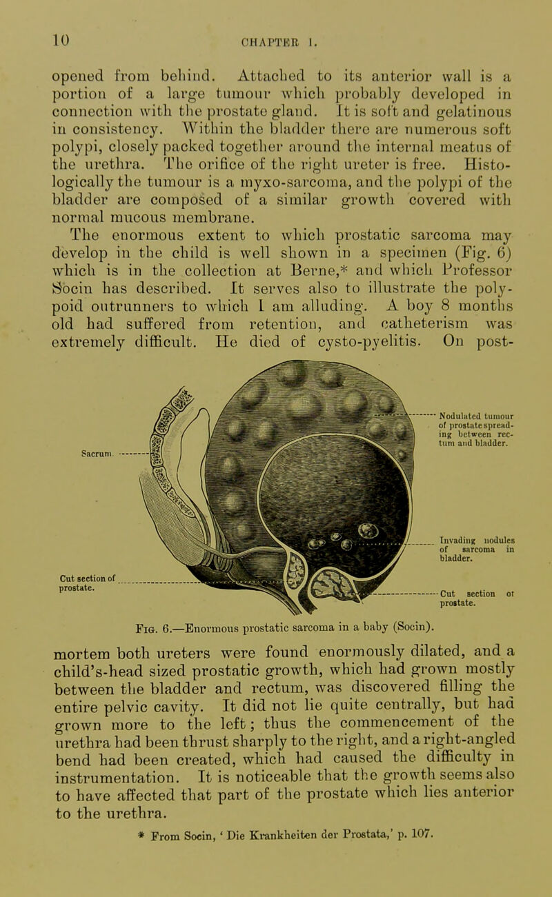 opened from behind. Attached to its anterior wall is a portion of a large tumour which probably developed in connection with the prostate gland. It is soft and gelatinous in consistency. Within the bladder there are numerous soft polypi, closely packed together around the internal meatus of the urethra. The orifice of the right ureter is free. Histo- logically the tumour is a myxo-sarcoma, and the polypi of the bladder are composed of a similar growth covered with normal mucous membrane. The enormous extent to which prostatic sarcoma may develop in the child is well shown in a specimen (Fig. 6) which is in the collection at Berne,* and which Professor Socin has described. It serves also to illustrate the poly- poid outrunners to which 1 am alluding. A boy 8 months old had suffered from retention, and catheterism was extremely difficult. He died of cysto-pyelitis. On post- Sacrum. Cut section of prostate. Fig. 6.—Enormous prostatic sarcoma in a baby (Socin). mortem both ureters were found enormously dilated, and a child's-head sized prostatic growth, which had grown mostly between the bladder and rectum, was discovered filling the entire pelvic cavity. It did not lie quite centrally, but had grown more to the left; thus the commencement of the urethra had been thrust sharply to the right, and a right-angled bend had been created, which had caused the difficulty in instrumentation. It is noticeable that the growth seems also to have affected that part of the prostate which lies anterior to the urethra. * From Socin, ' Die Krankheiten der Prostata,' p. 107.