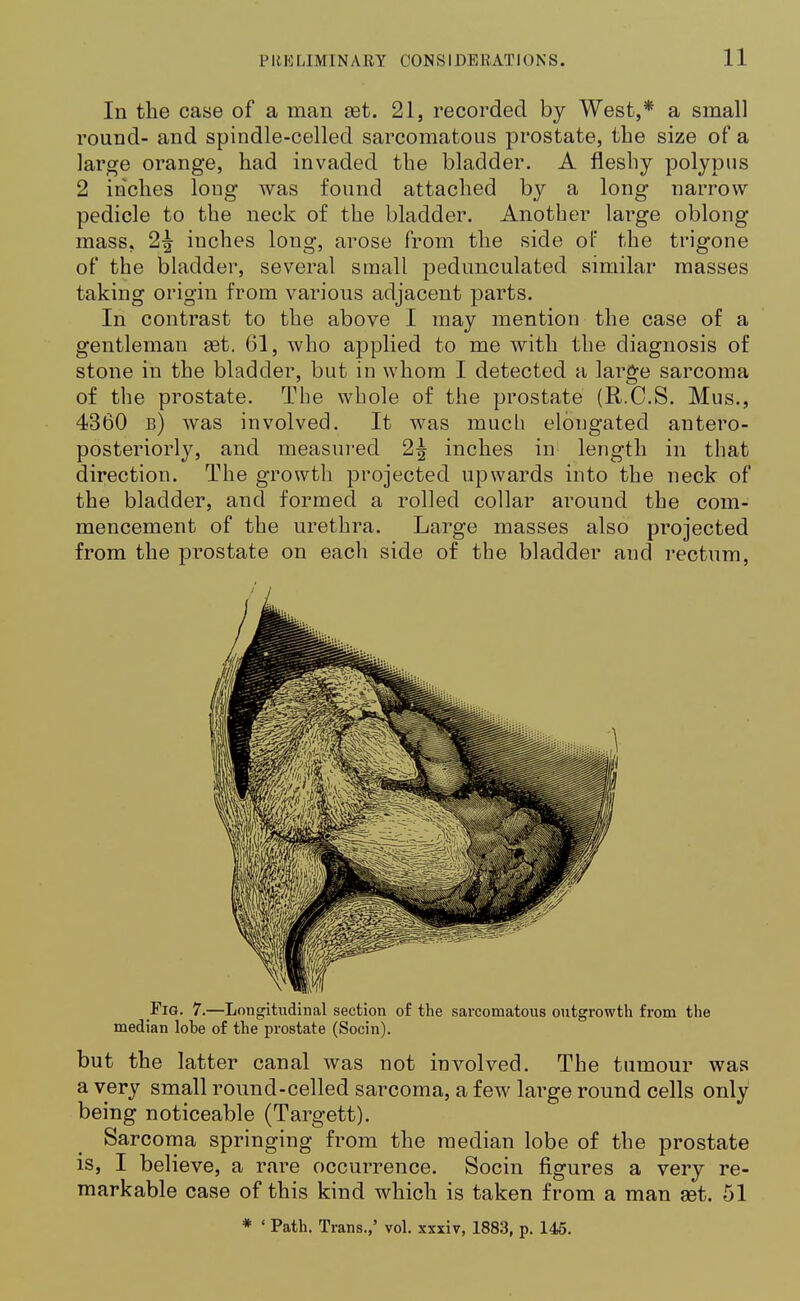 In the case of a man set. 21, recorded by West,* a small round- and spindle-celled sarcomatous prostate, the size of a large orange, had invaded the bladder. A fleshy polypus 2 inches long was found attached by a long narrow pedicle to the neck of the bladder. Another large oblong mass. 2\ inches long, arose from the side of the trigone of the bladder, several small pedunculated similar masses taking origin from various adjacent parts. In contrast to the above I may mention the case of a gentleman get. 61, who applied to me with the diagnosis of stone in the bladder, but in whom I detected a large sarcoma of the prostate. The whole of the prostate (R.C.S. Mus., 4360 b) was involved. It was much elongated antero- posteriorly, and measured 2^ inches in length in that direction. The growth projected upwards into the neck of the bladder, and formed a rolled collar around the com- mencement of the urethra. Large masses also projected from the prostate on each side of the bladder and rectum, Fig. 7.—Longitudinal section of the sarcomatous outgrowth from the median lohe of the prostate (Socin). but the latter canal was not involved. The tumour was a very small round-celled sarcoma, a few large round cells only being noticeable (Targett). Sarcoma springing from the median lobe of the prostate is, I believe, a rare occurrence. Socin figures a very re- markable case of this kind which is taken from a man aet. 51