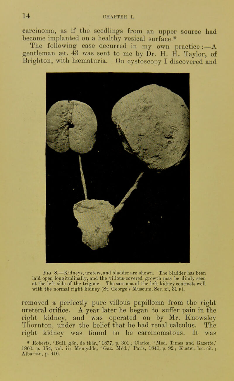 carcinoma, as if the seedlings from an upper source had become implanted on a healthy vesical surface.* The following case occurred in my own practice :—A gentleman set. 43 was sent to me by Dr. H. H. Taylor, of Brighton, with hematuria. On cystoscopy I discovered and Fig. 8.—Kidneys, ureters, and bladder are shown. The bladder lias been laid open longitudinally, and the villous-covered growth may be dimly seen at the left side of the trigone. The sarcoma of the left kidney contrasts well with the normal right kidney (St. George's Museum, Ser. xi, 31 f). removed a perfectly pure villous papilloma from the right ureteral orifice. A year later he began to suffer pain in the right kidney, and was operated on by Mr. Knowsley Thornton, under the belief that he had renal calculus. The right kidney was found to be carcinomatous. It was * Roberts, ' Bull. gen. de thcr.,' 1877, p. 301; Clarke, 'Med. Times and Gazette,* 1860. p. 154, vol. ii; Mengalde, ' Gaz. Med.,' Paris, 1840, p. 92; Kuster. loc. cit.; Albarran, p. 416.